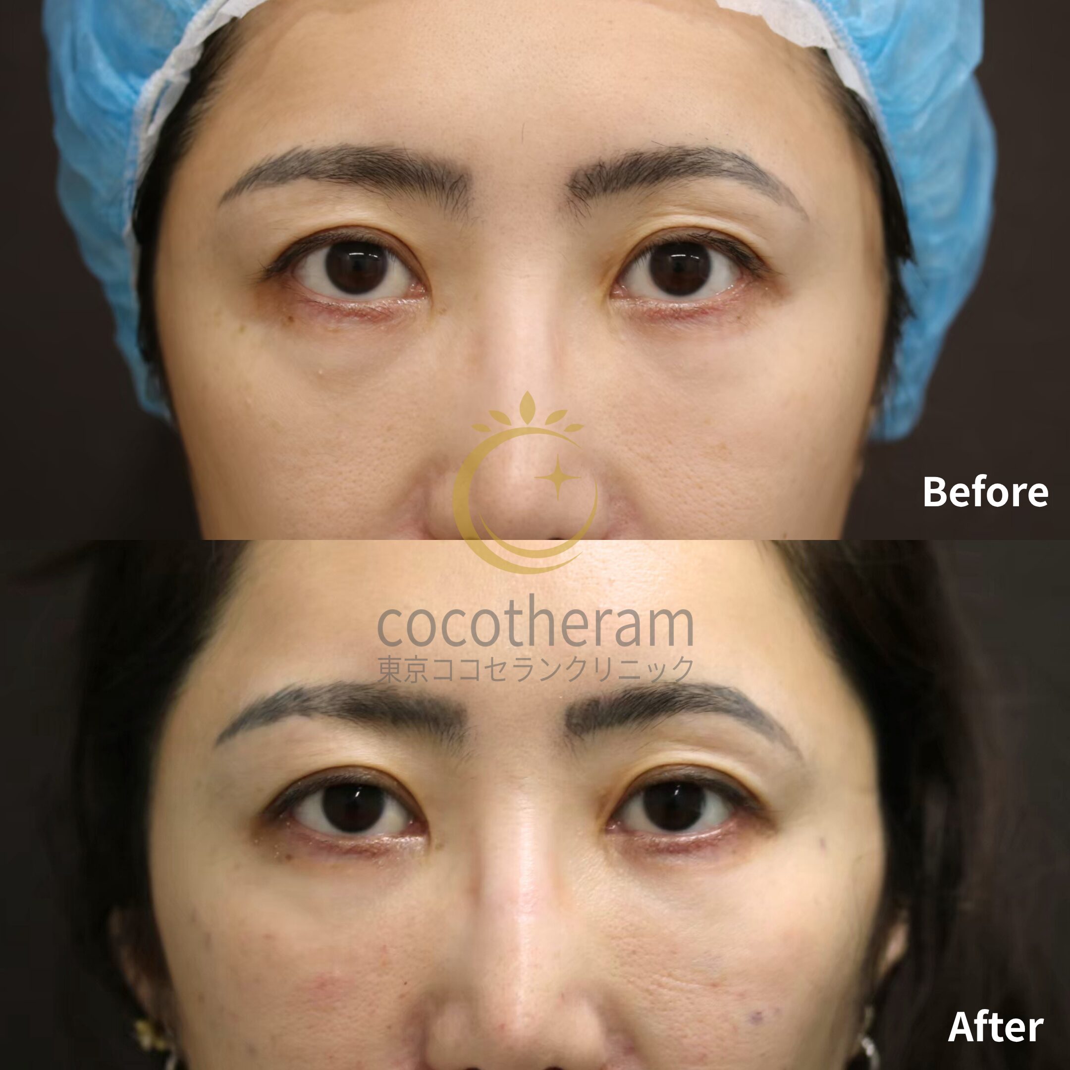 経結膜脱脂術 / 脂肪注入