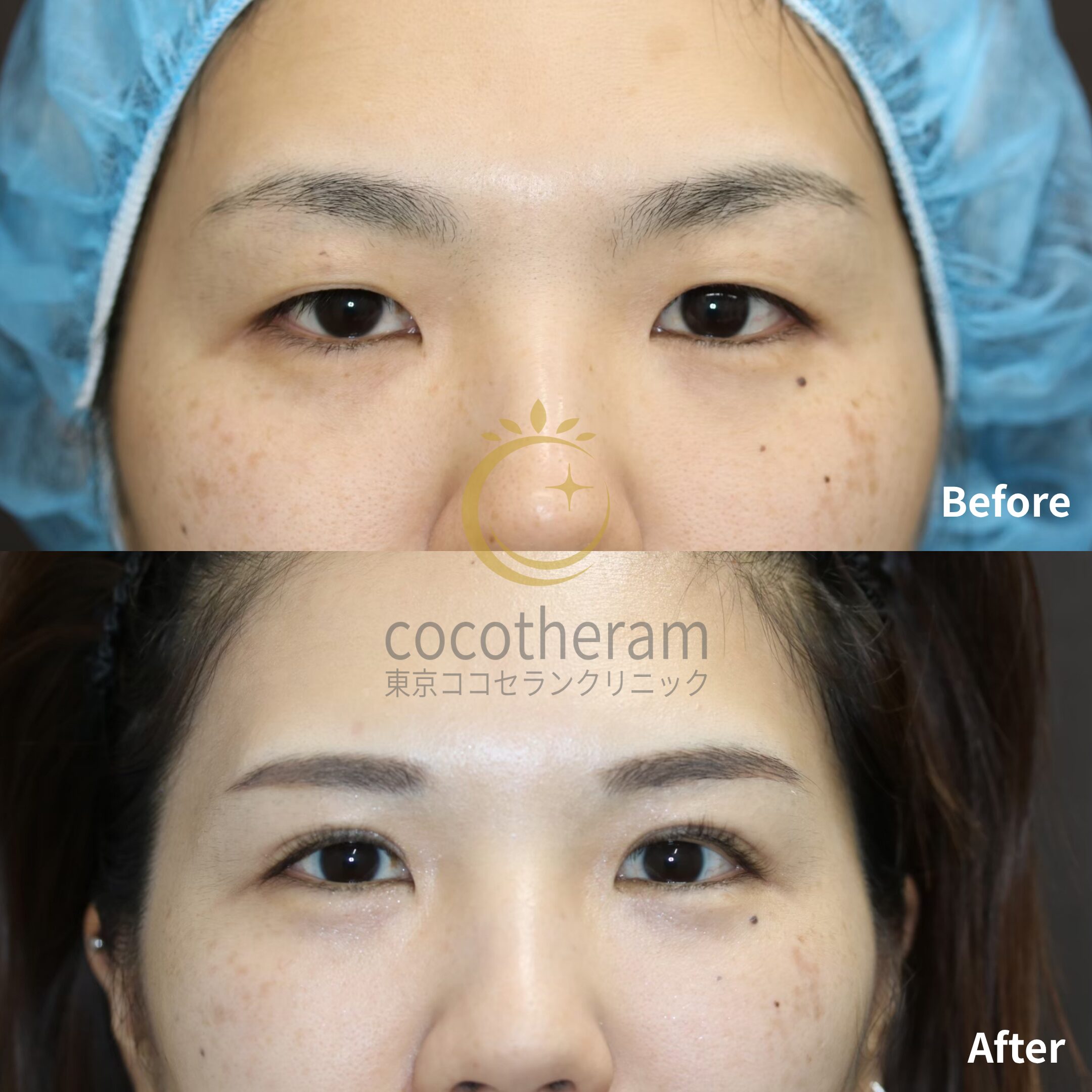 眼瞼下垂症手術 / 二重切開法