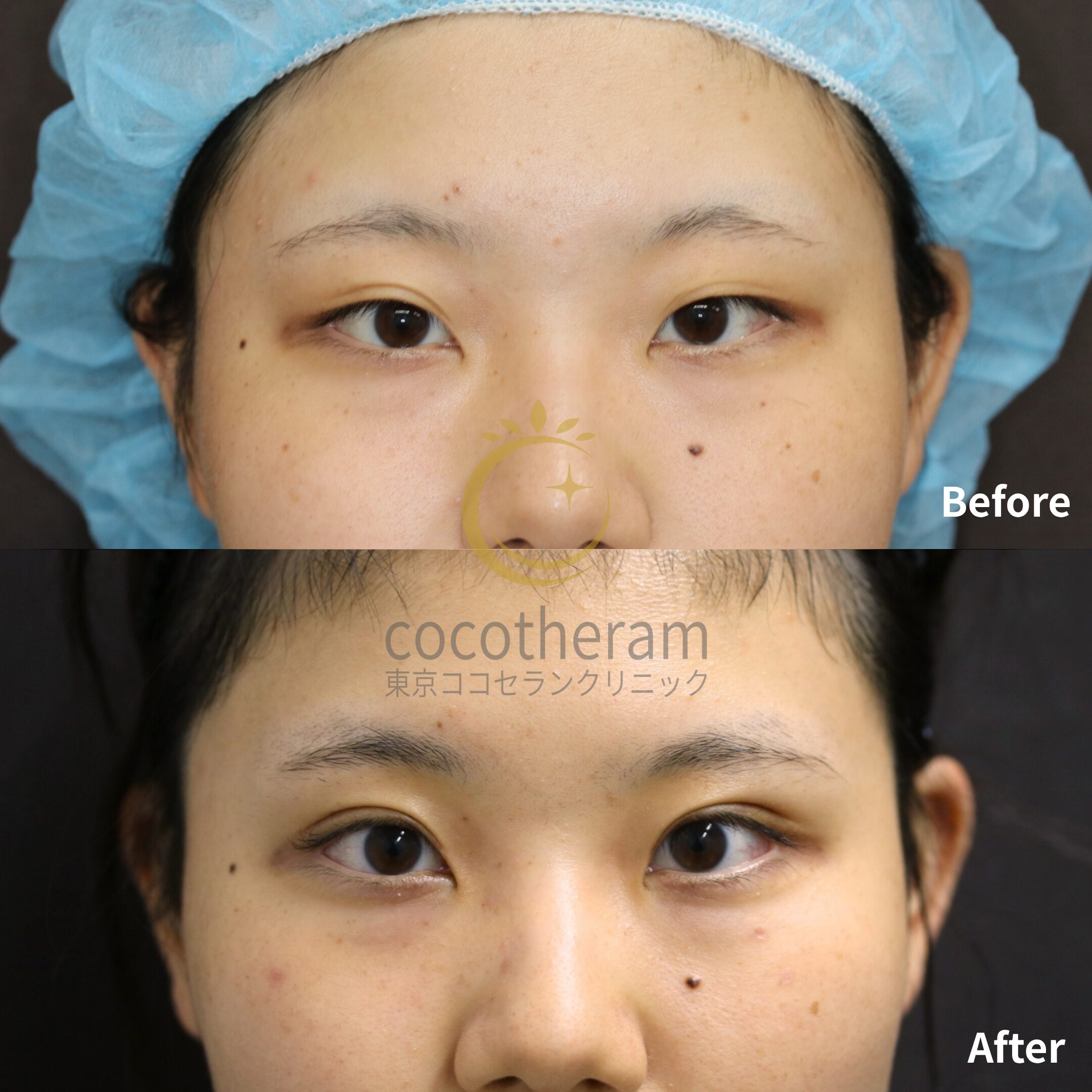 眼瞼下垂症手術 / 二重埋没抜糸法