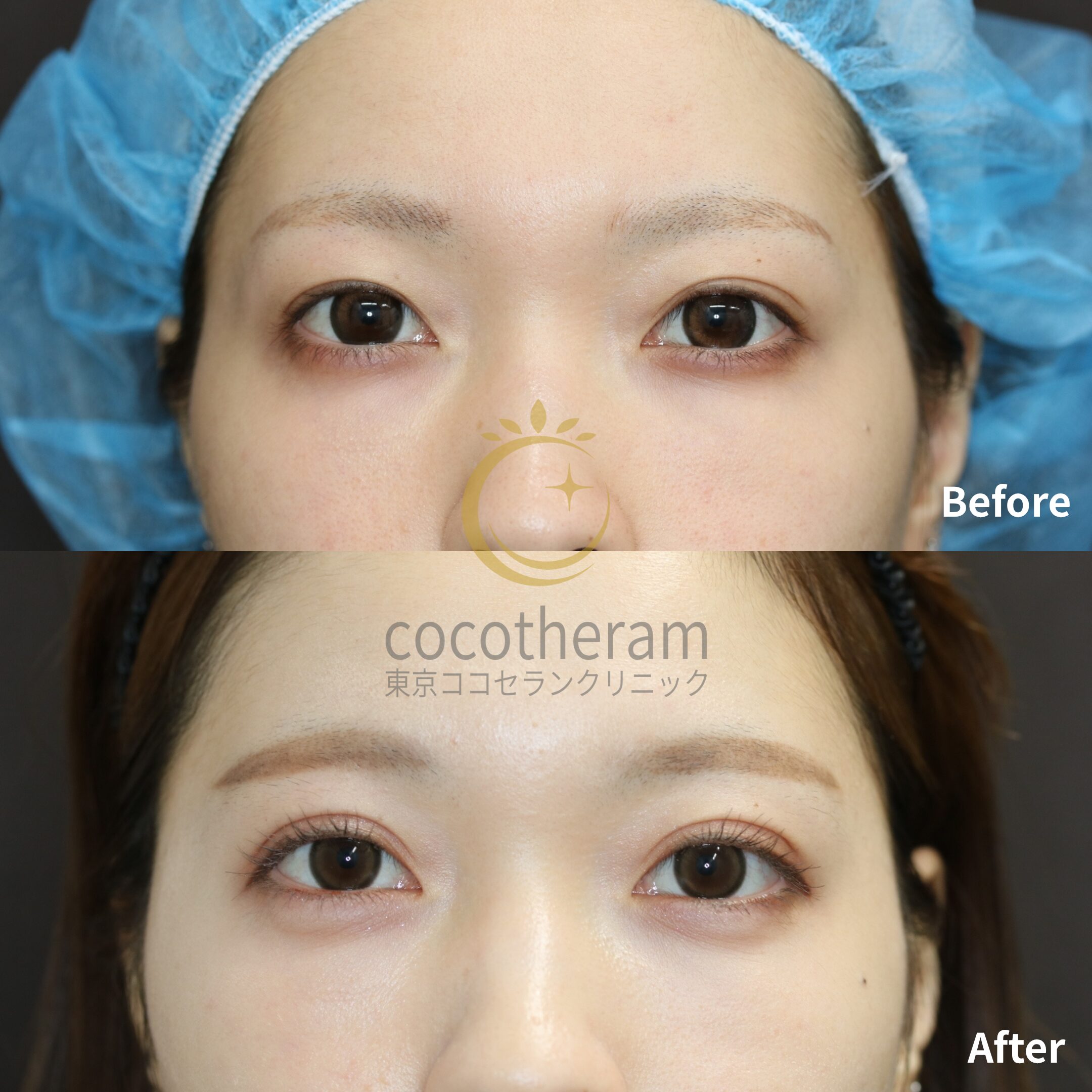 二重埋没法3点留め