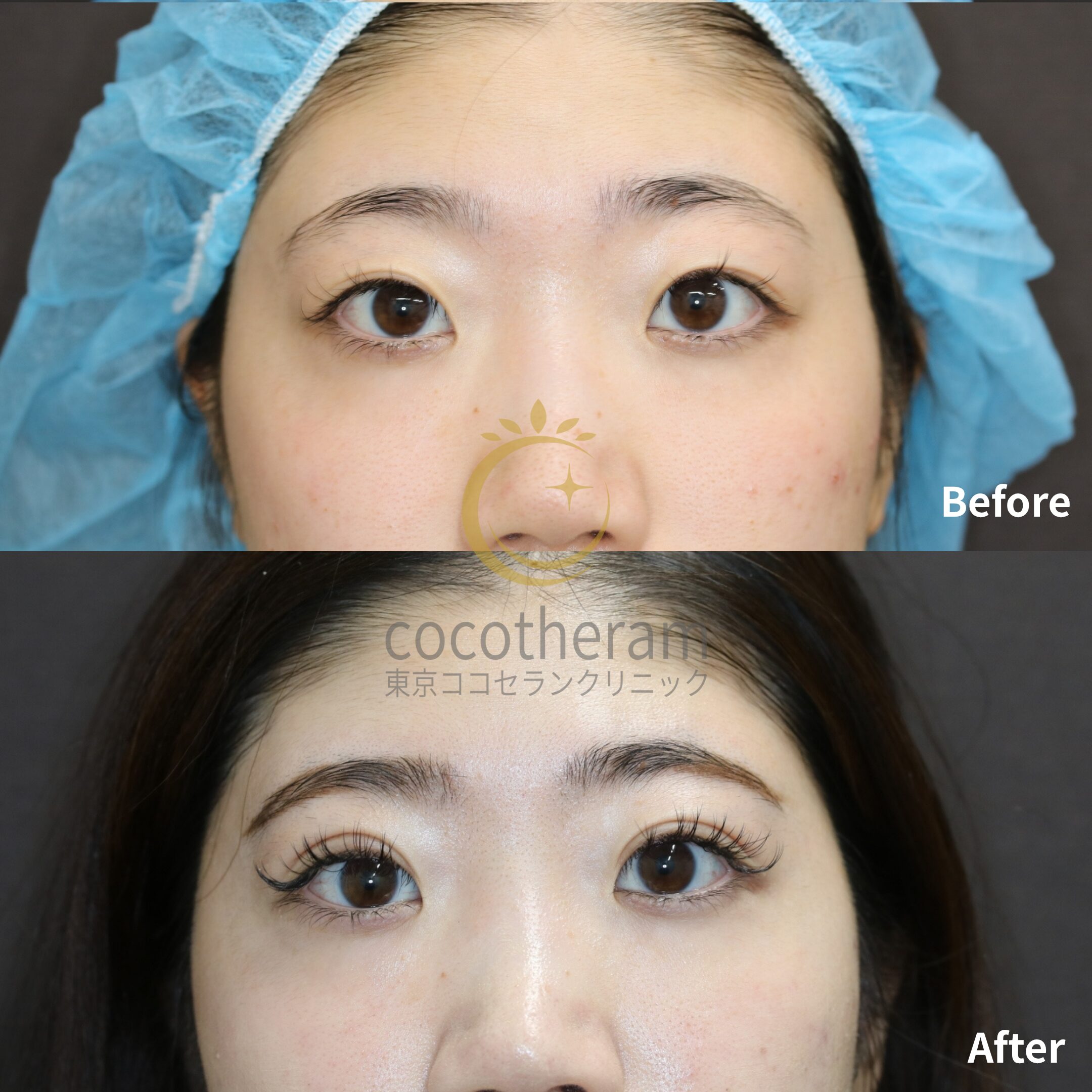 二重埋没法3点留め