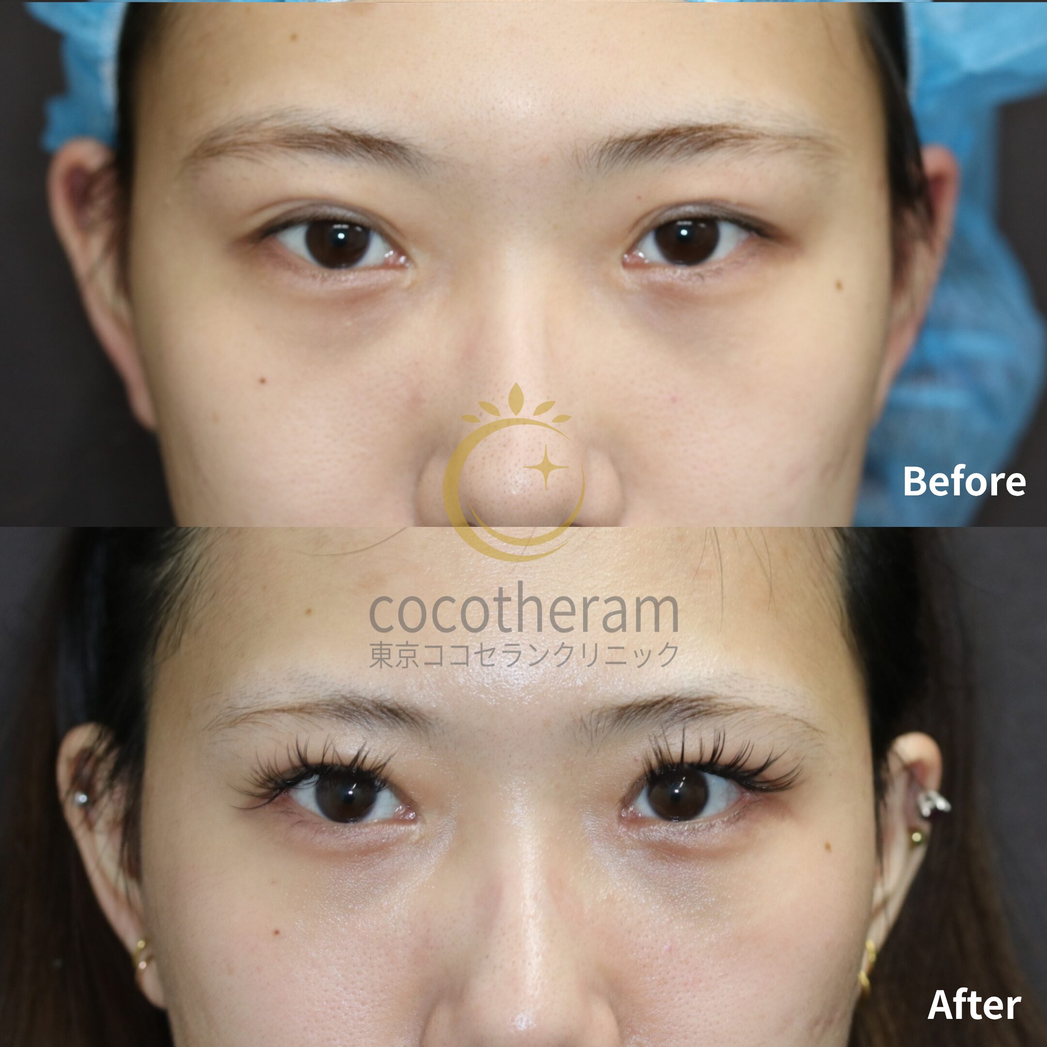 目頭切開 / 眼瞼下垂症手術 / 二重埋没抜糸法 / 眉下切開 / グラマラスライン形成