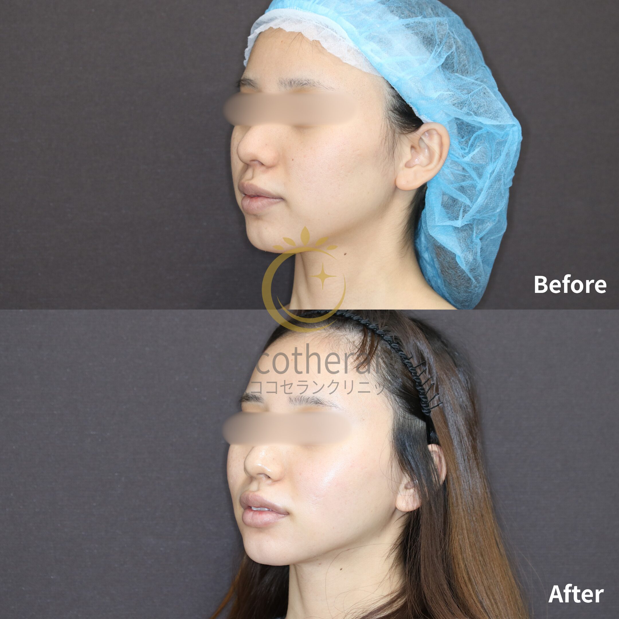 小顔マジック / 脂肪注入