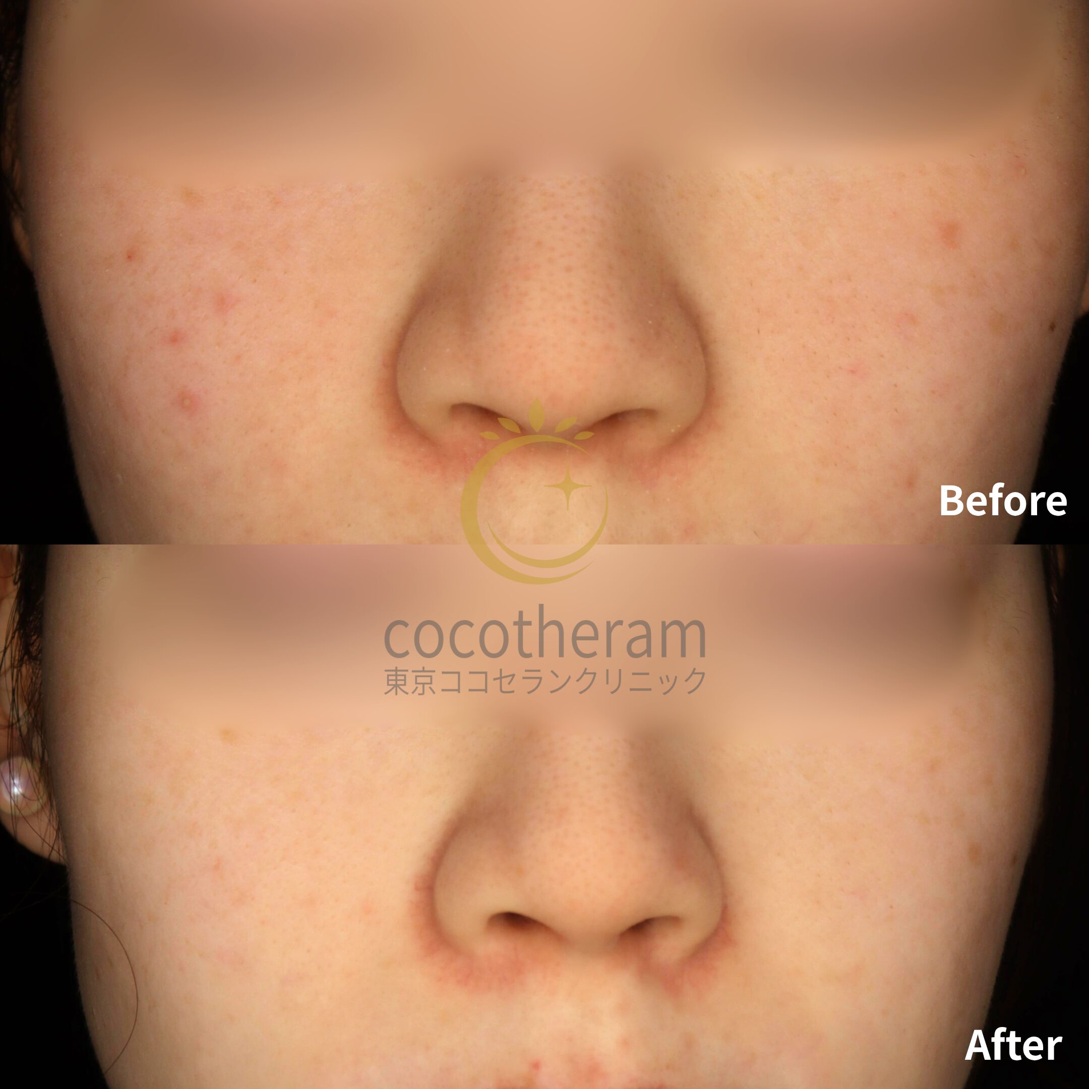 アドバテックスレーザー