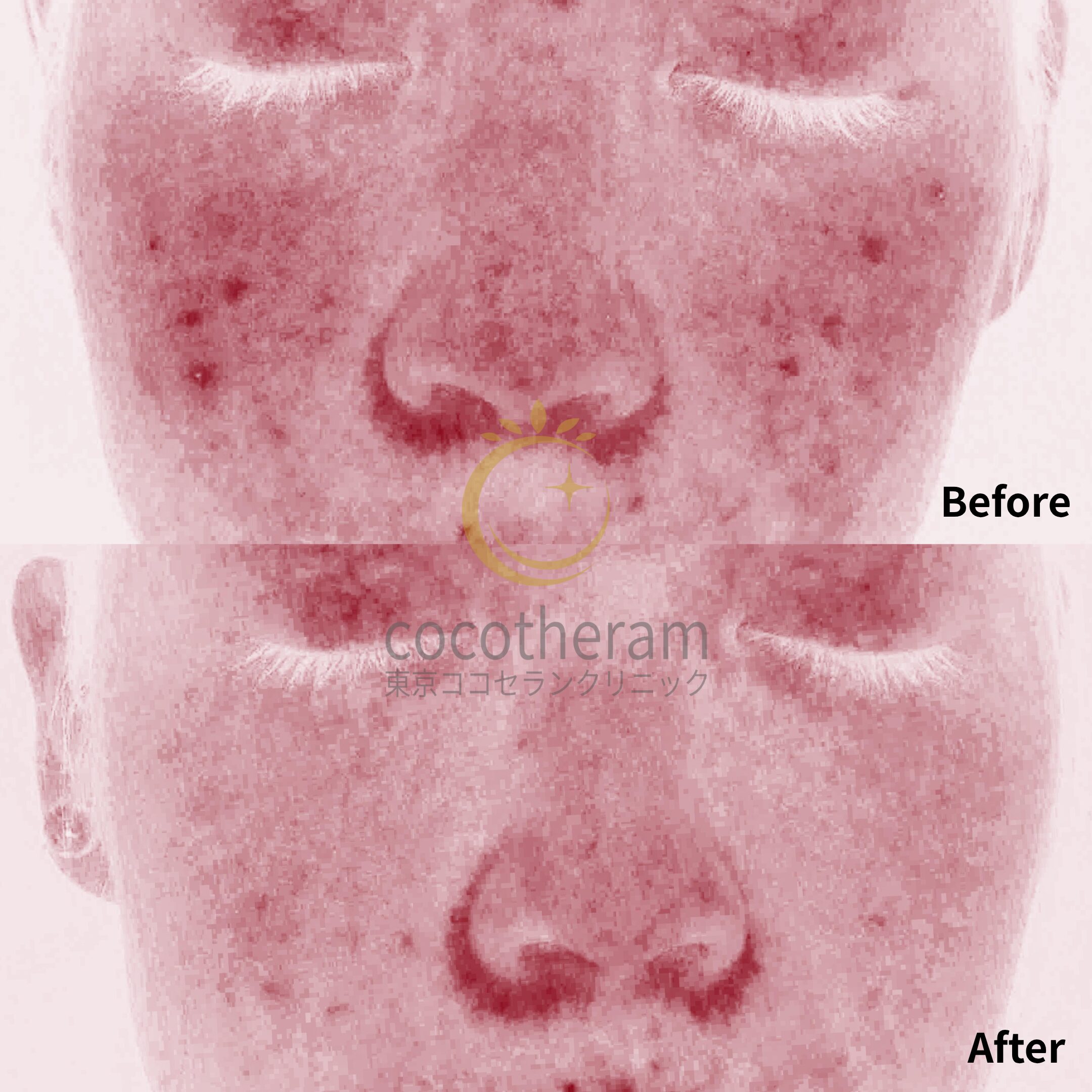 アドバテックスレーザー