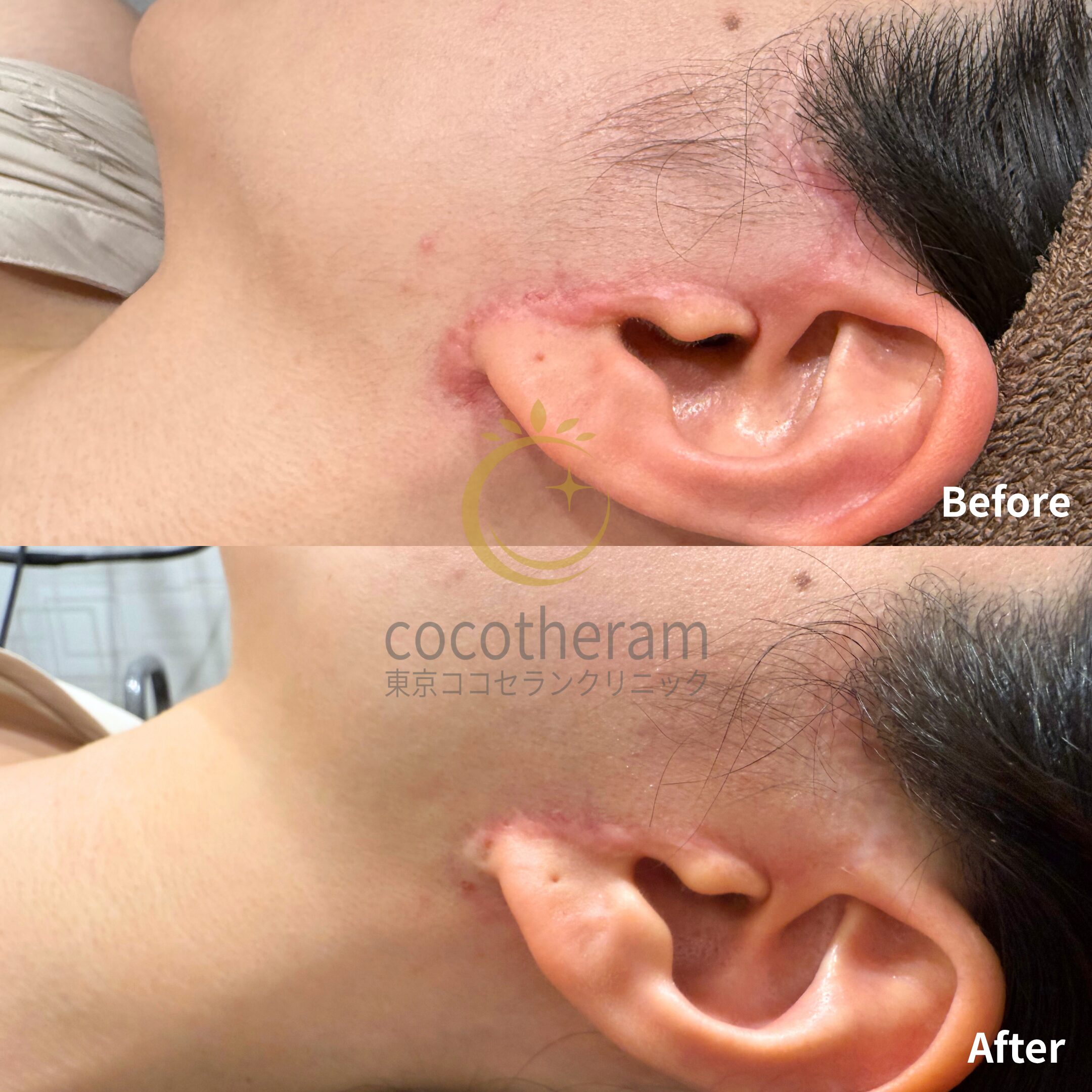 アドバテックスレーザー