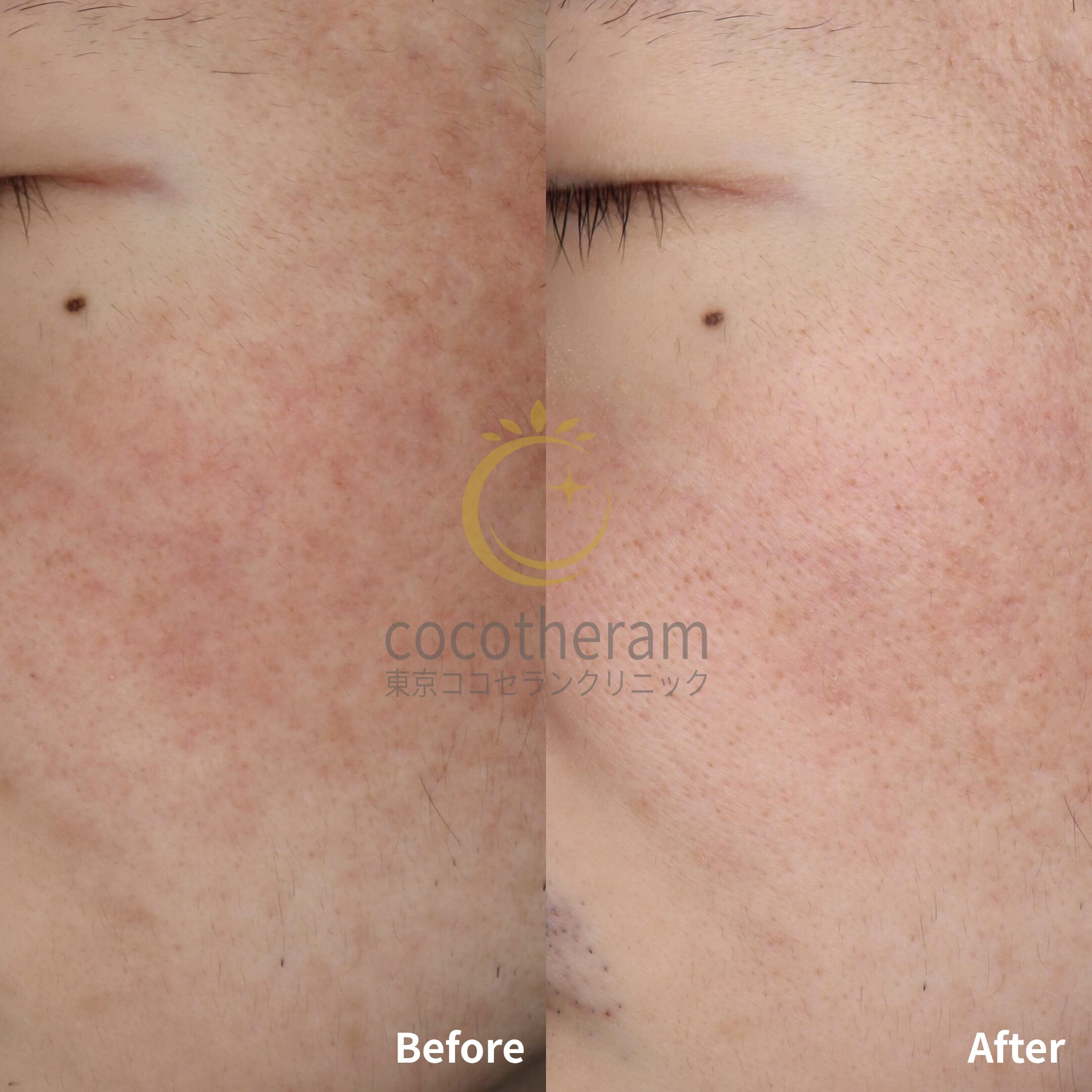 アドバテックスレーザー