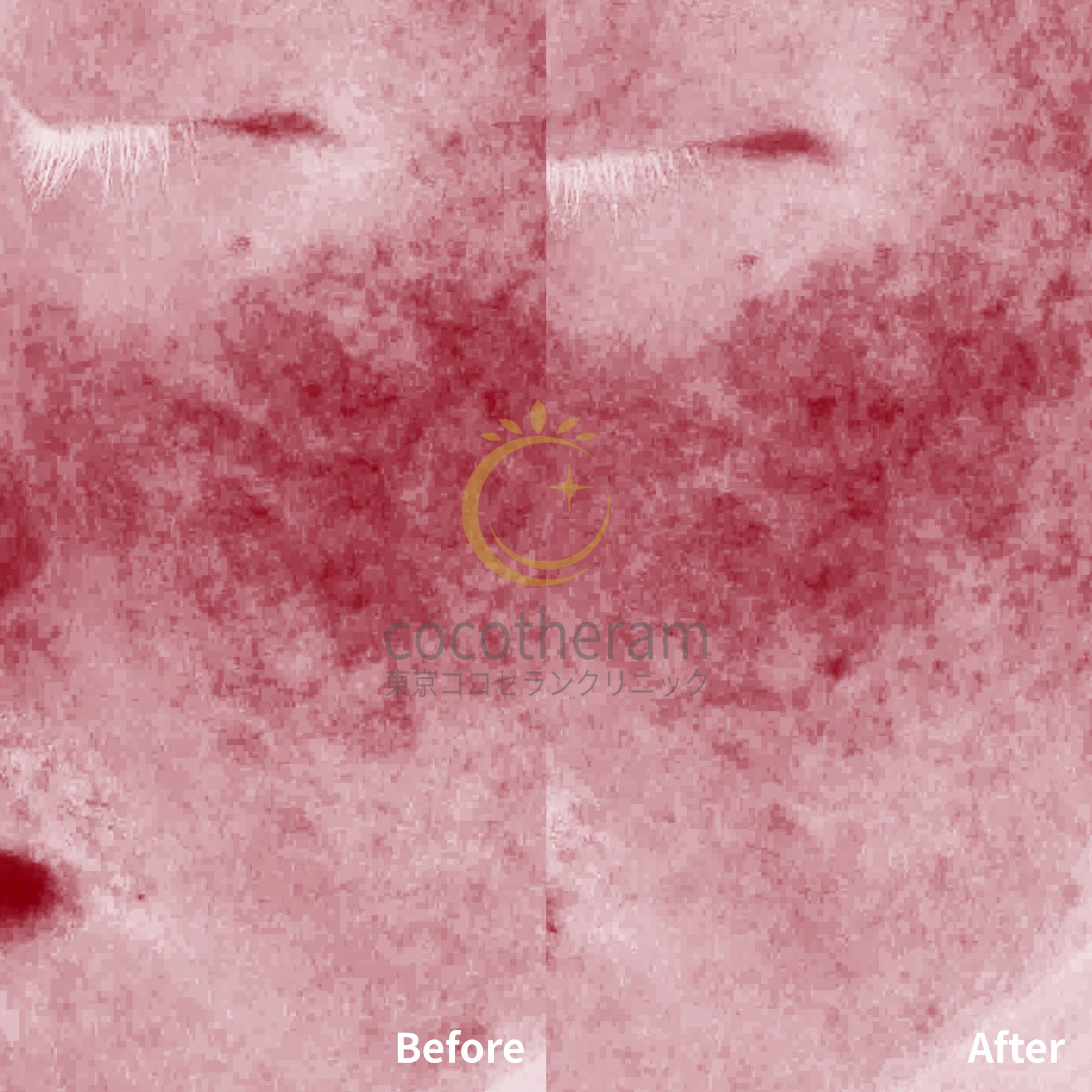 アドバテックスレーザー