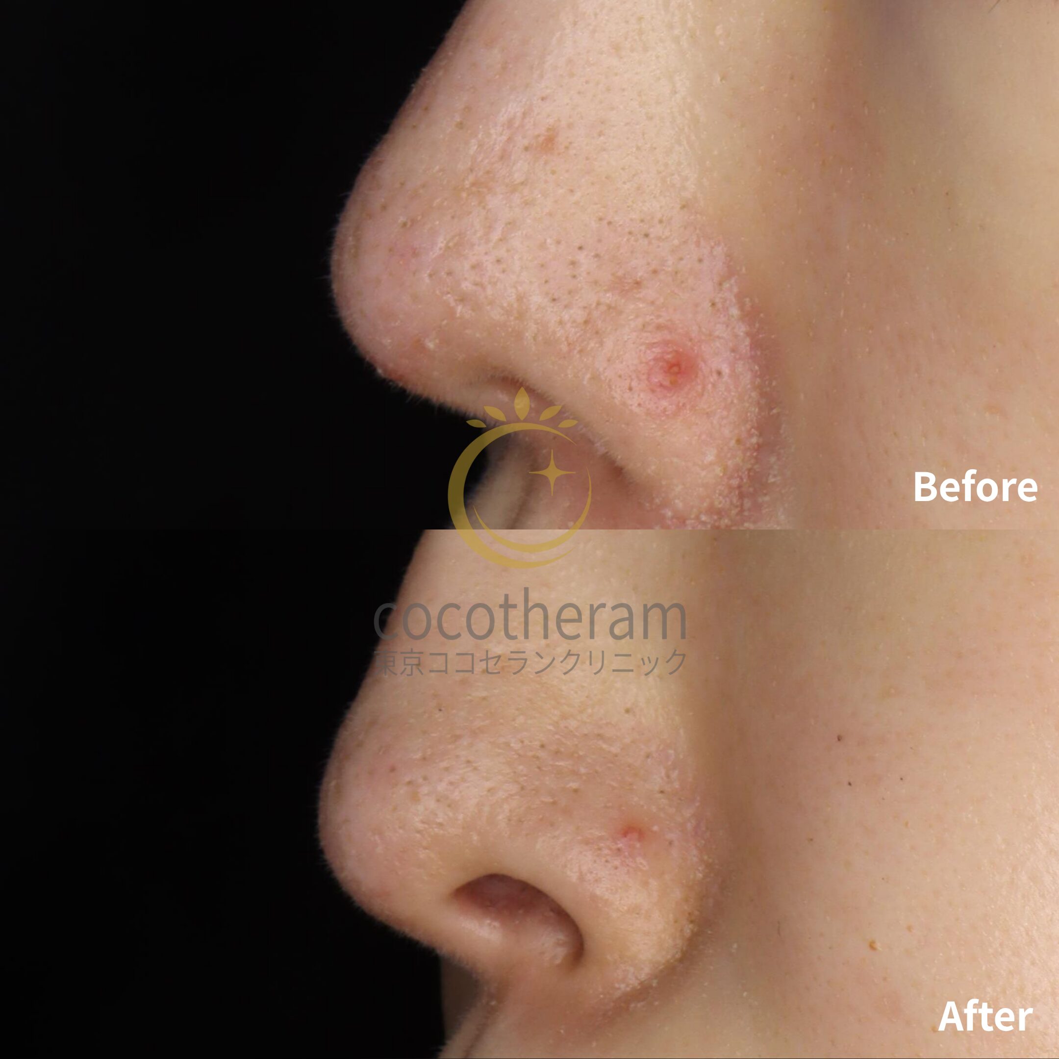 アドバテックスレーザー