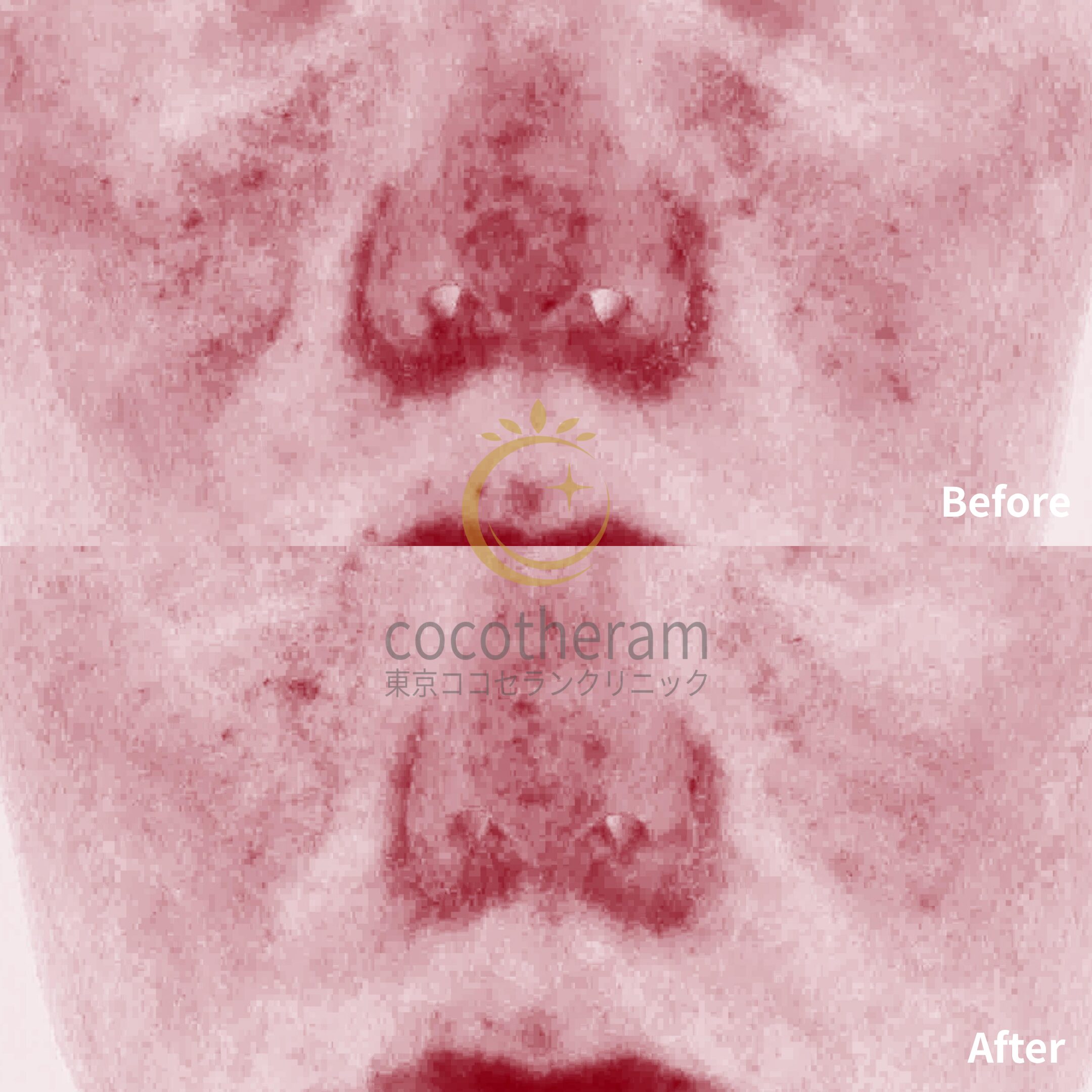 アドバテックスレーザー