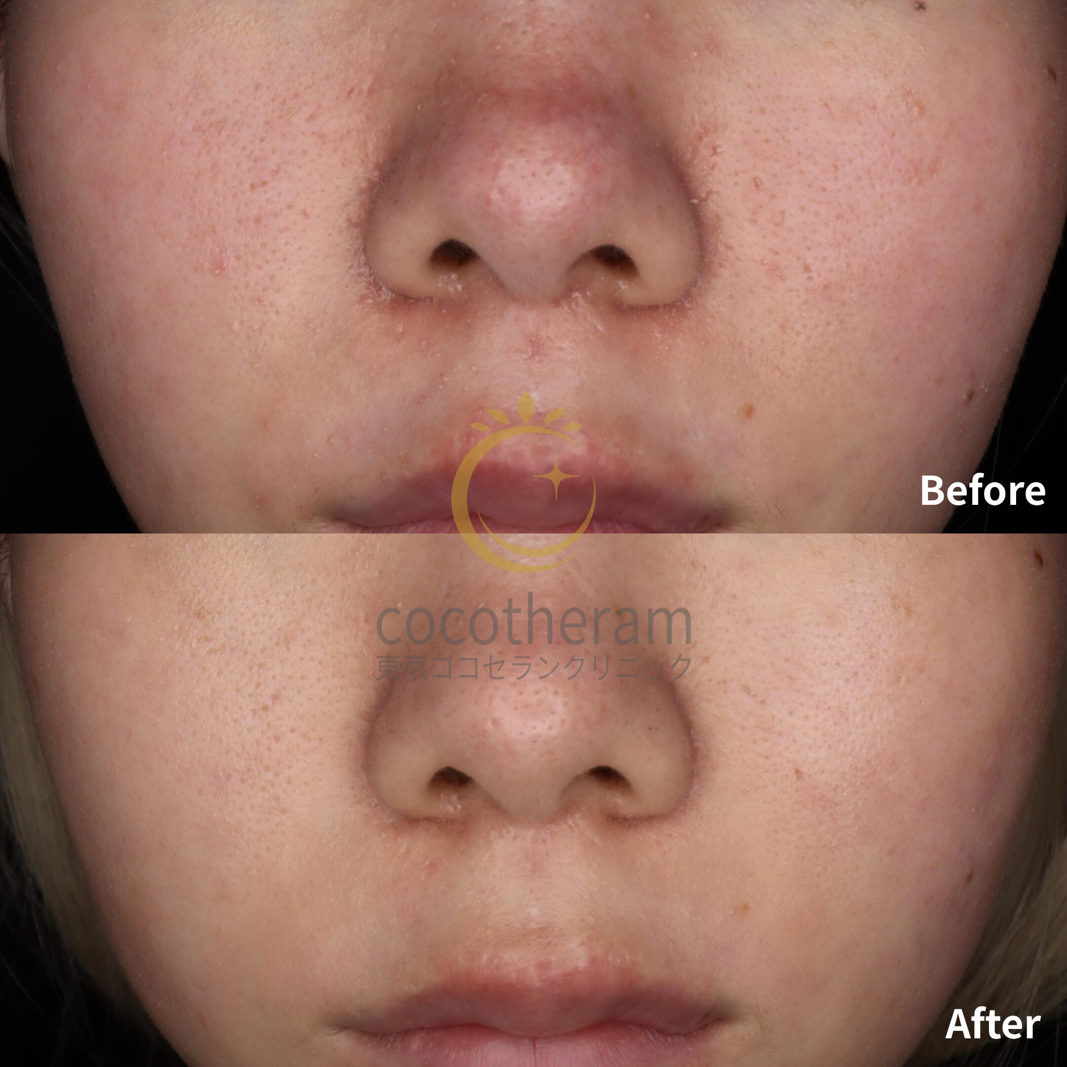 アドバテックスレーザー