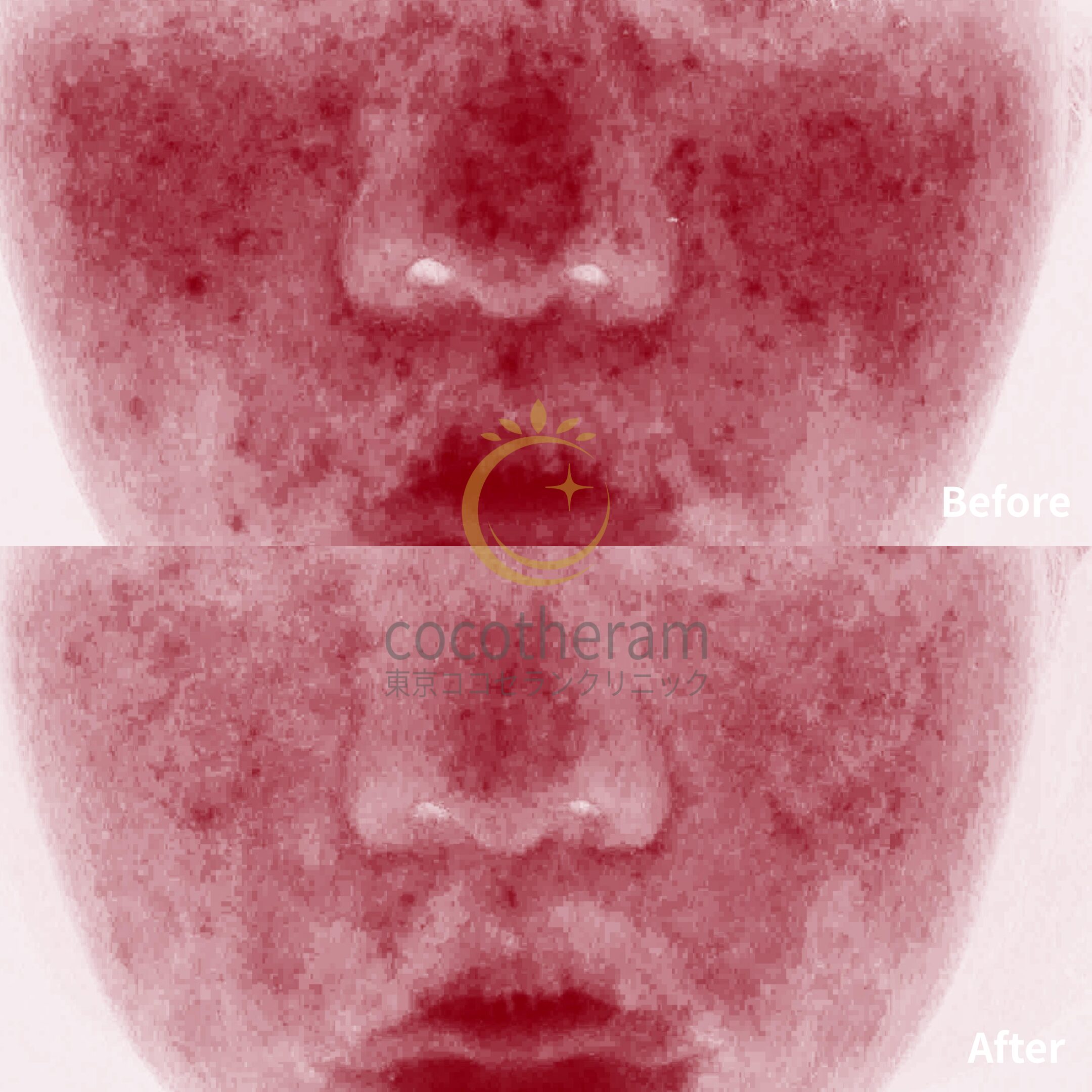 アドバテックスレーザー