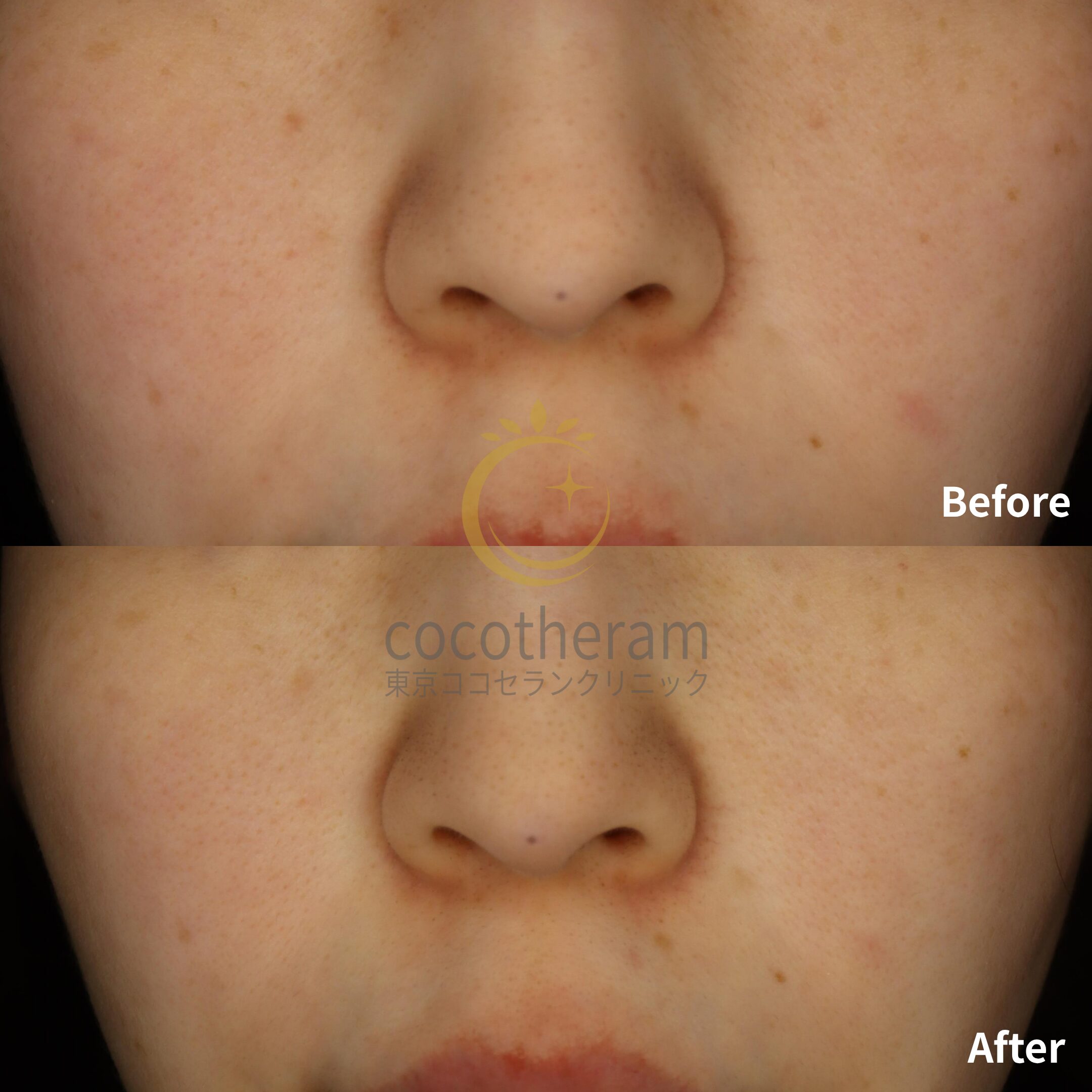 アドバテックスレーザー