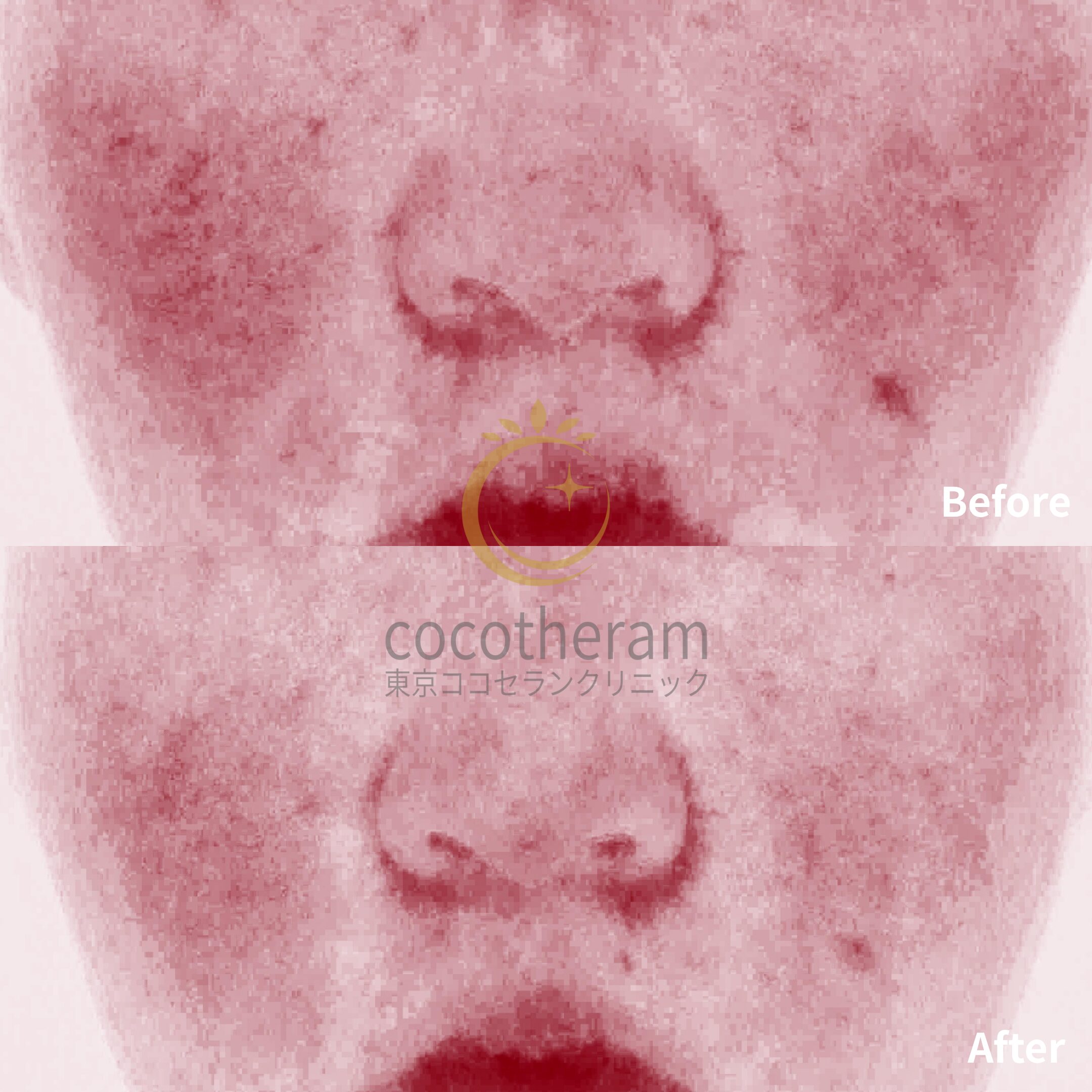 アドバテックスレーザー