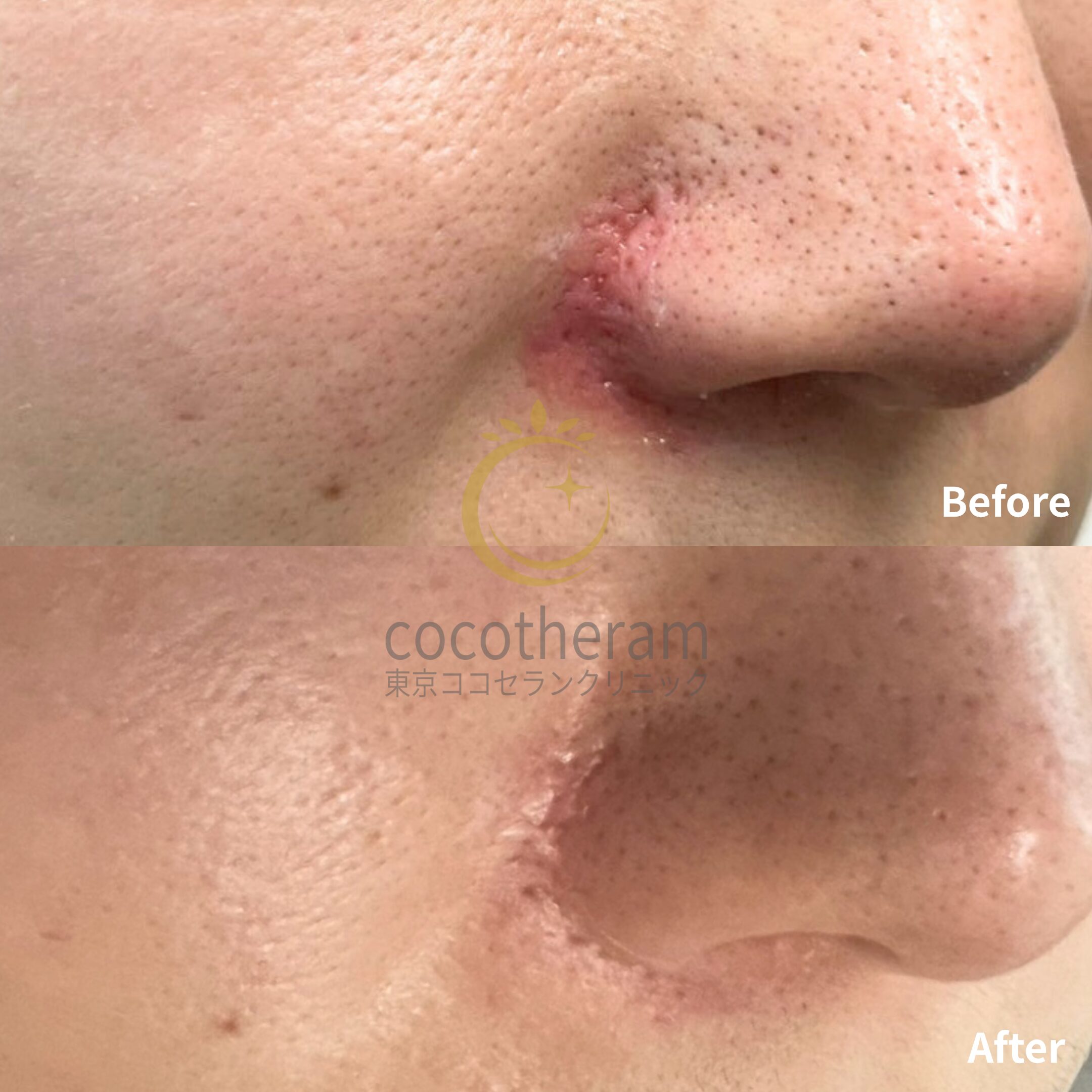 アドバテックスレーザー