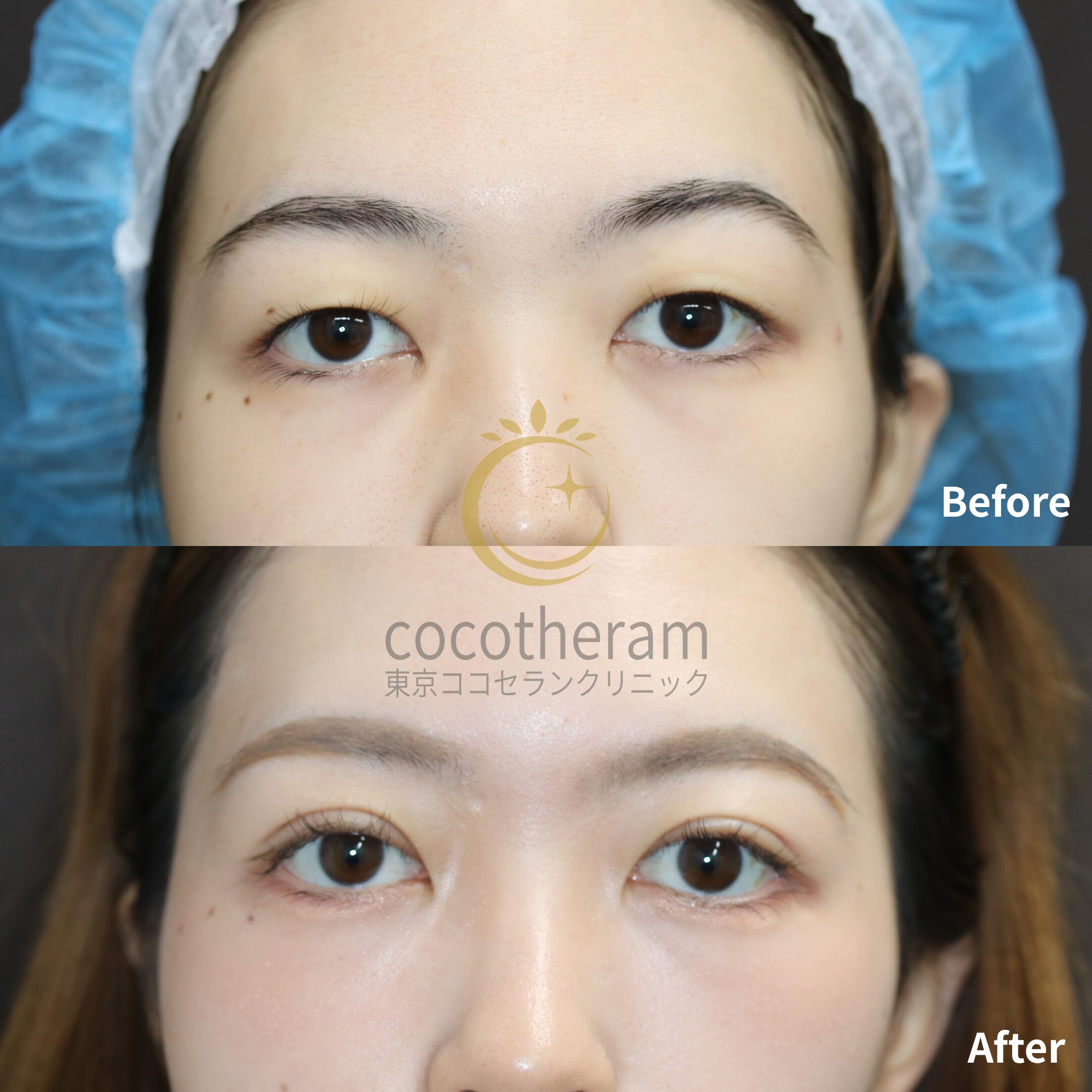 二重埋没法6点留め