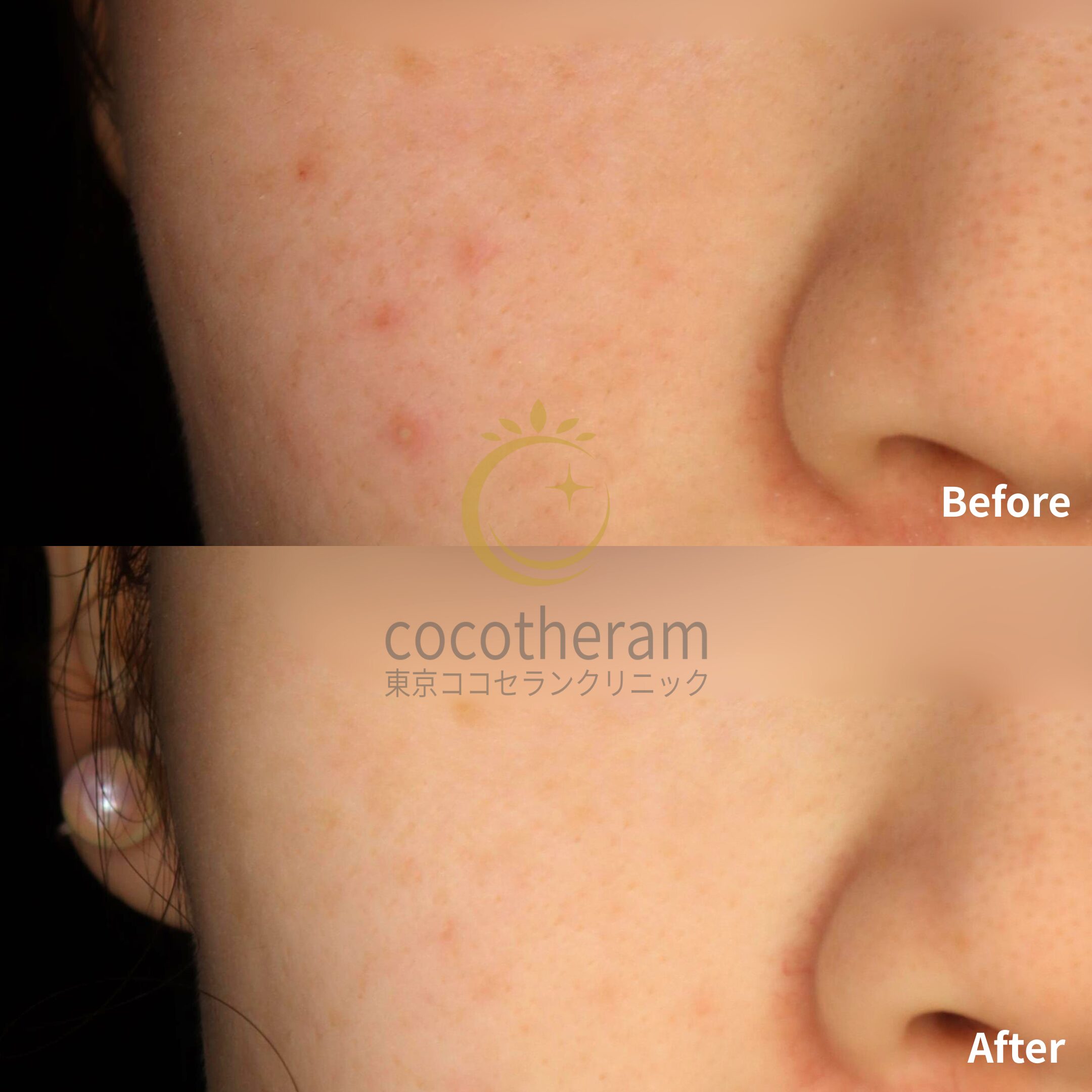 アドバテックスレーザー