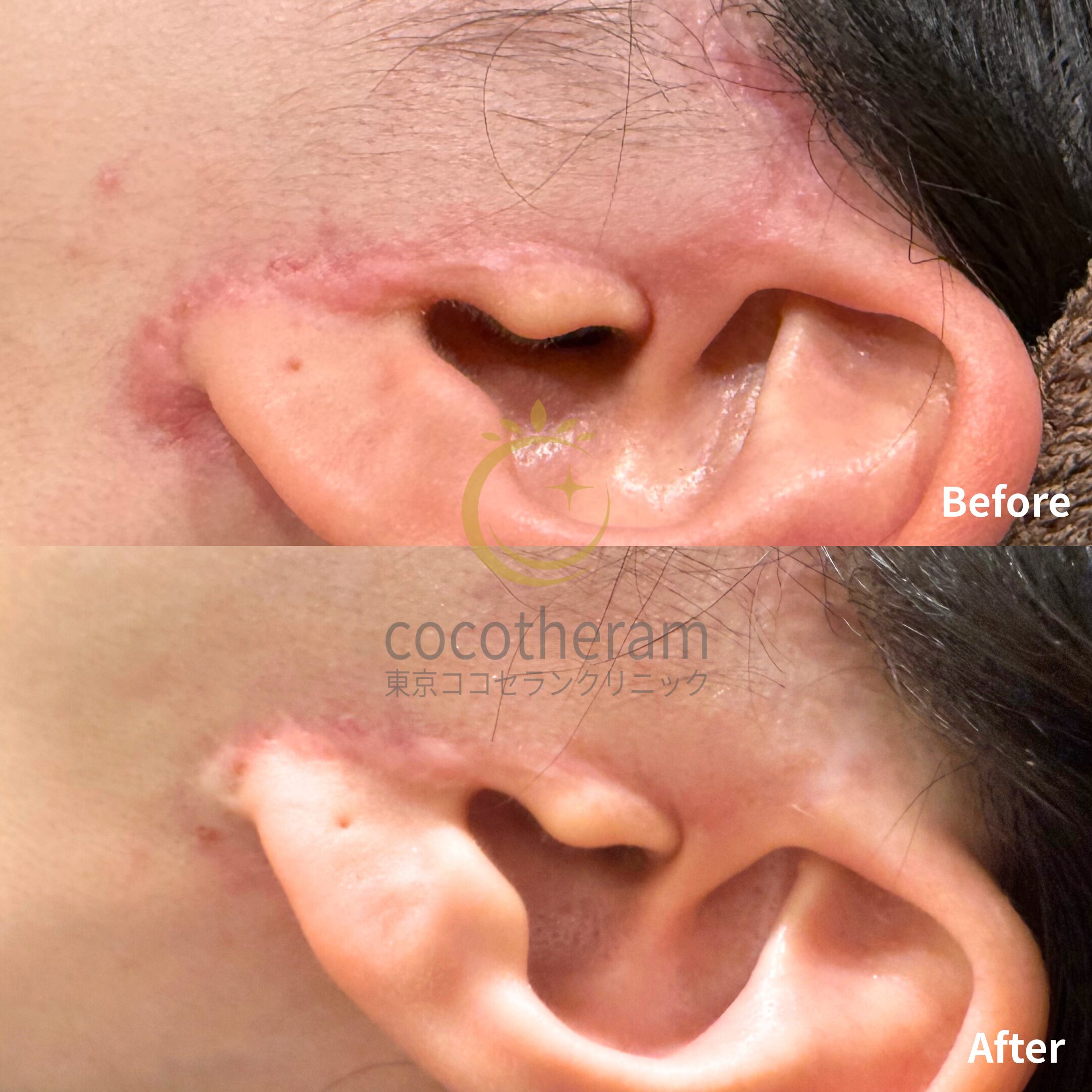 アドバテックスレーザー