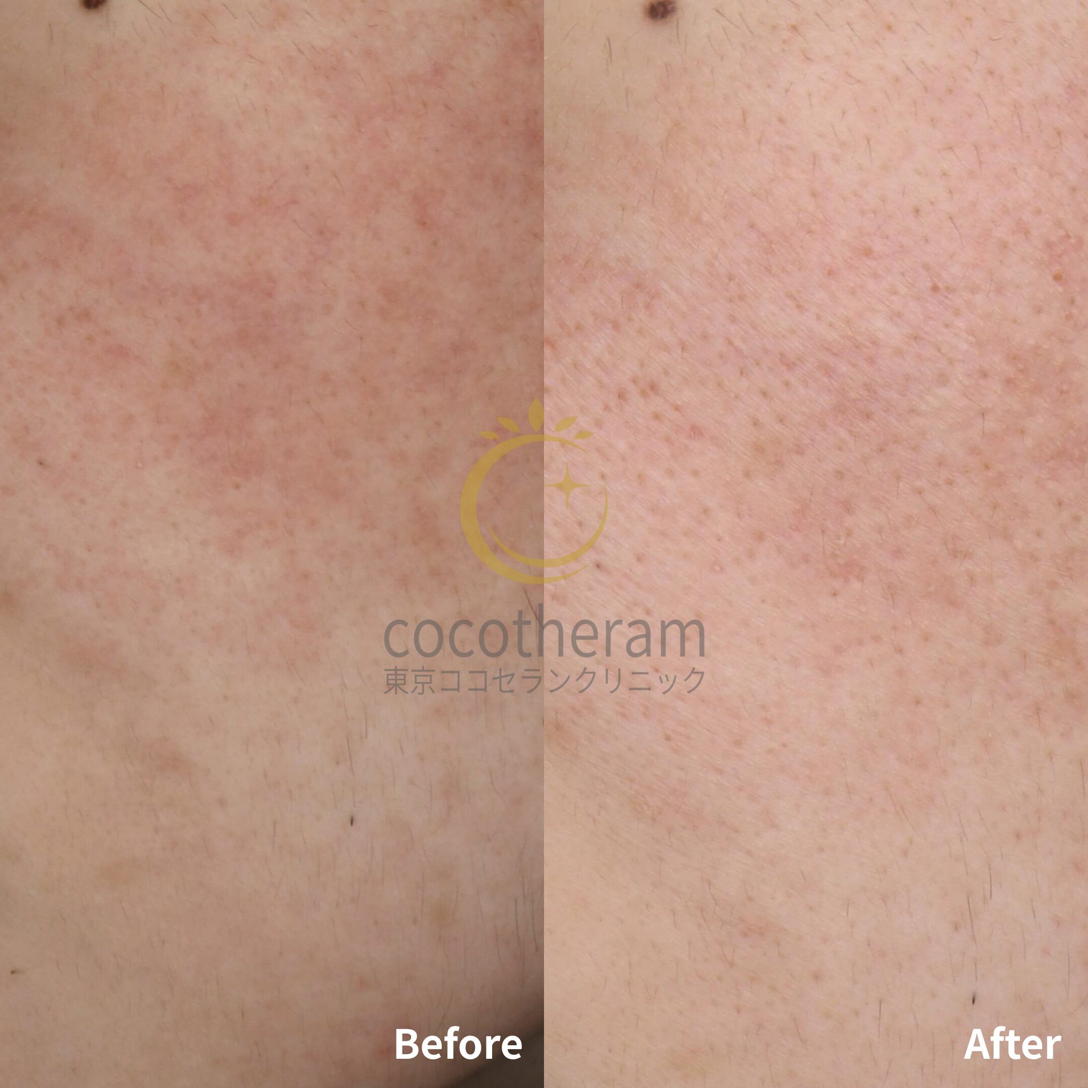 アドバテックスレーザー