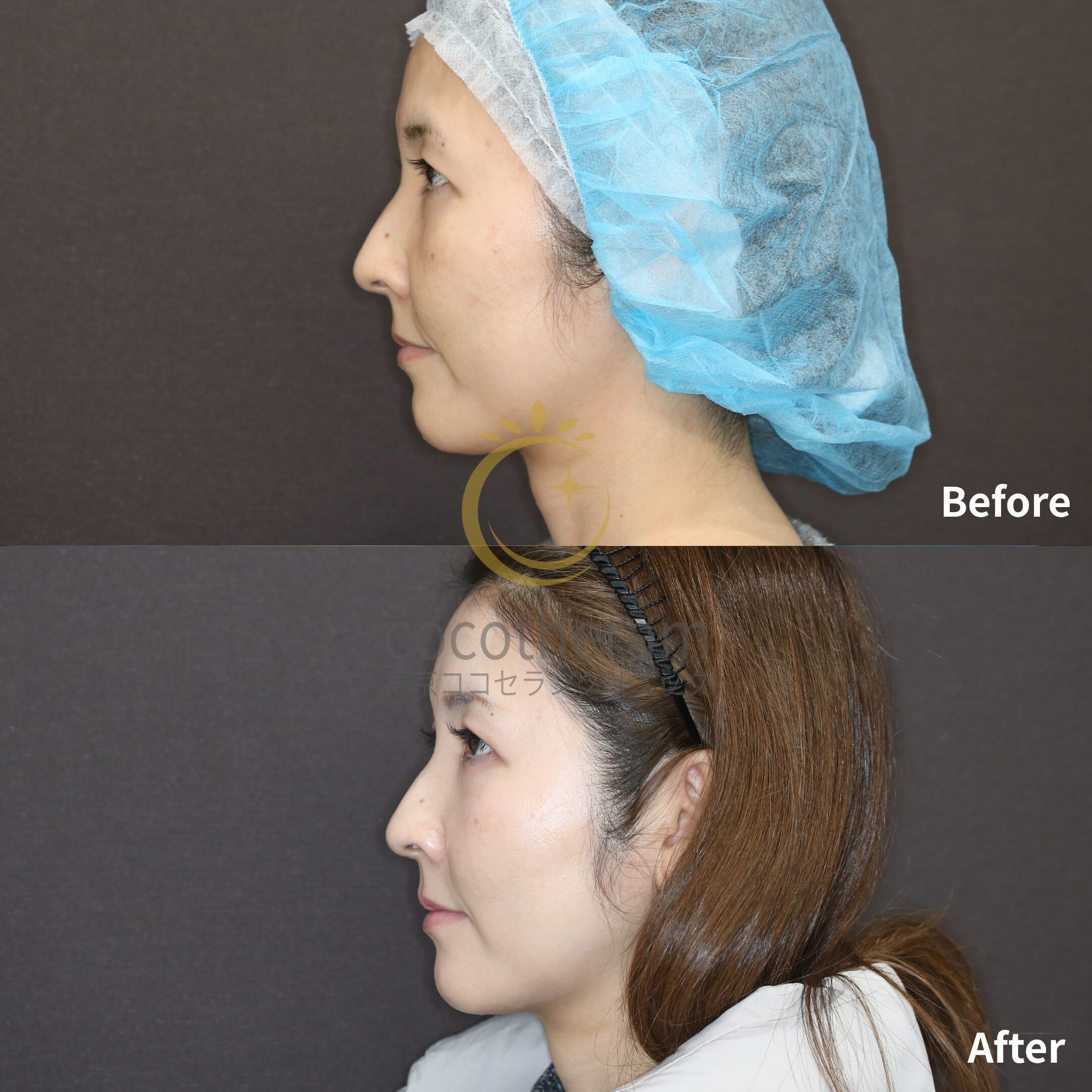 スレッドリフト