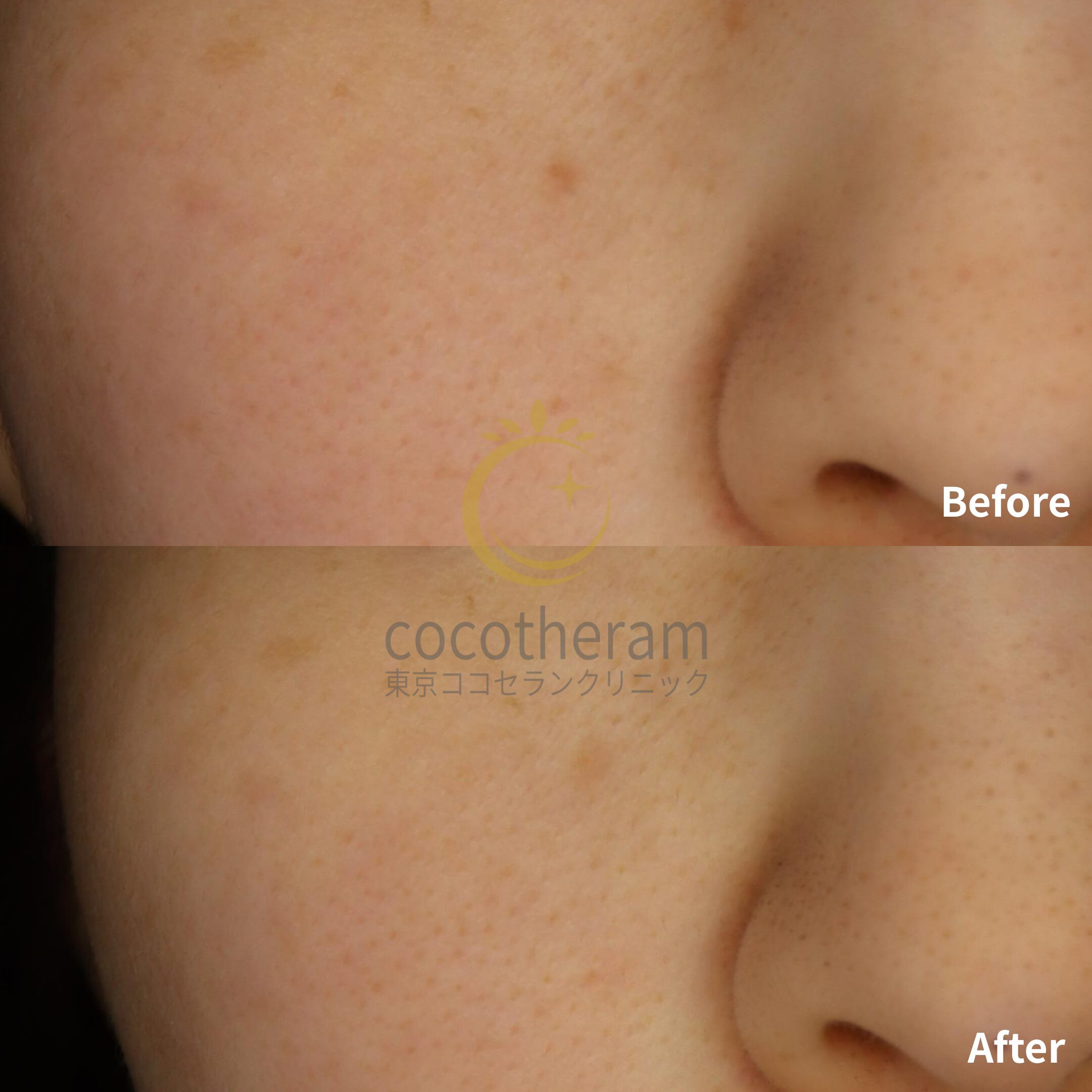 アドバテックスレーザー