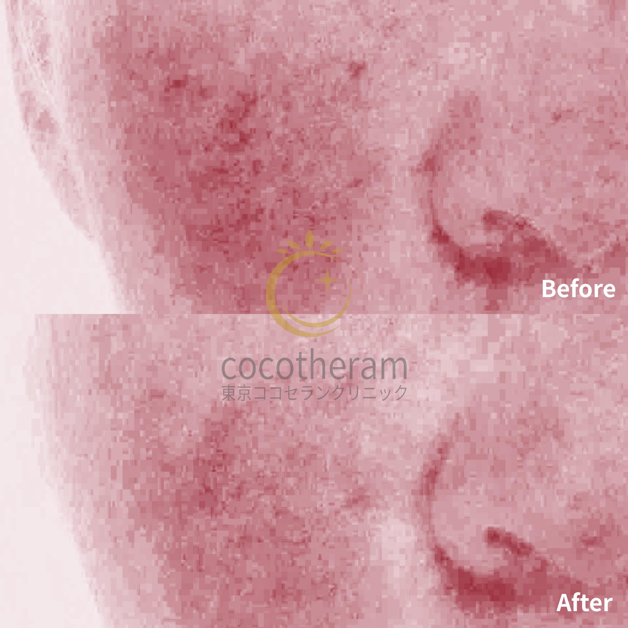 アドバテックスレーザー