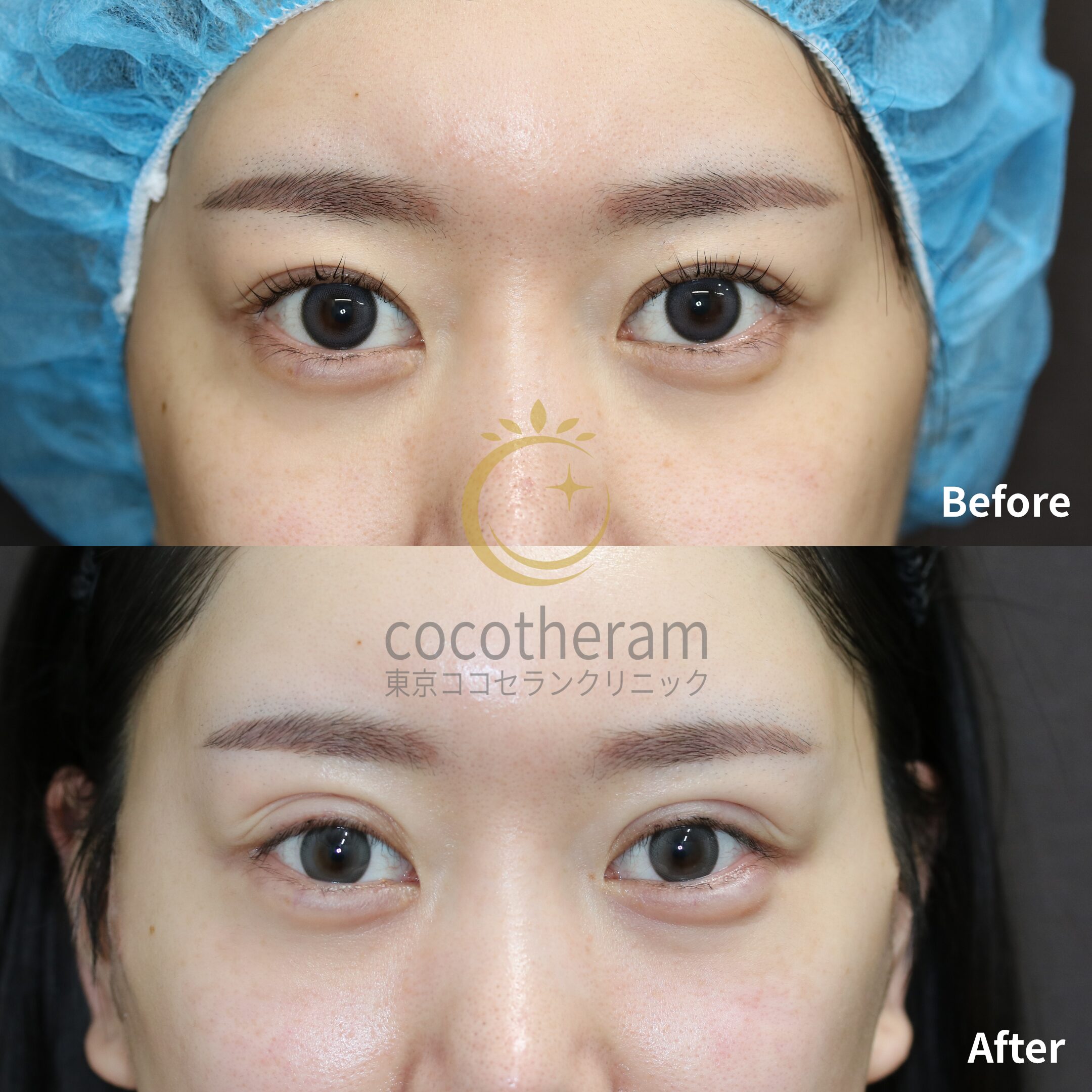 二重埋没法6点留め