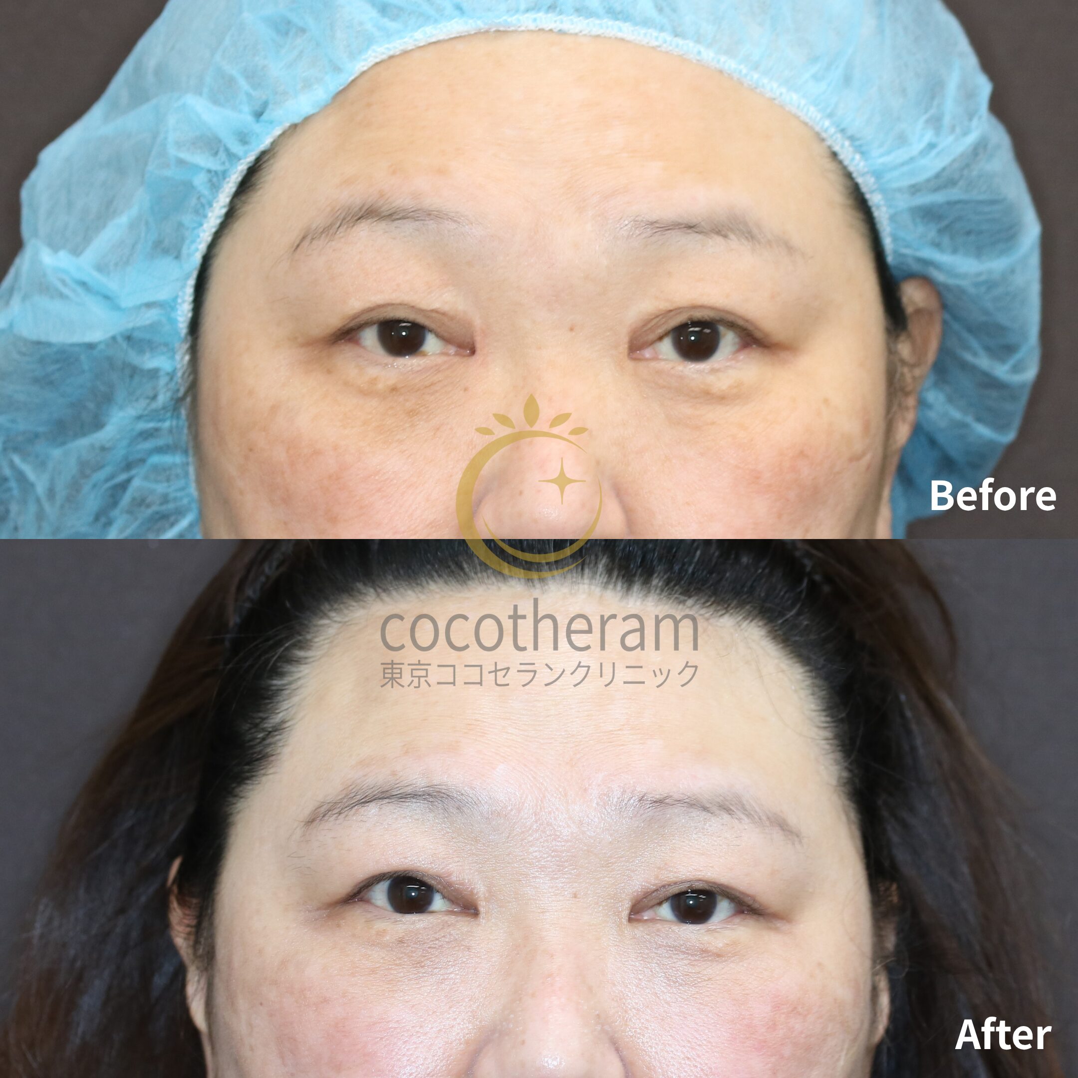 眼瞼下垂症手術 / 二重切開法