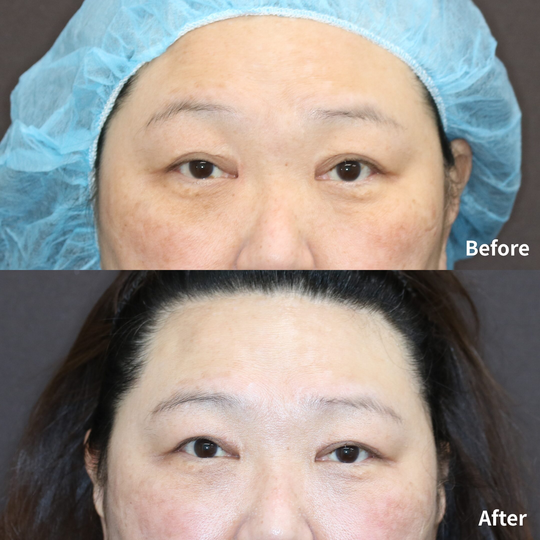 眼瞼下垂症手術 / 二重切開法