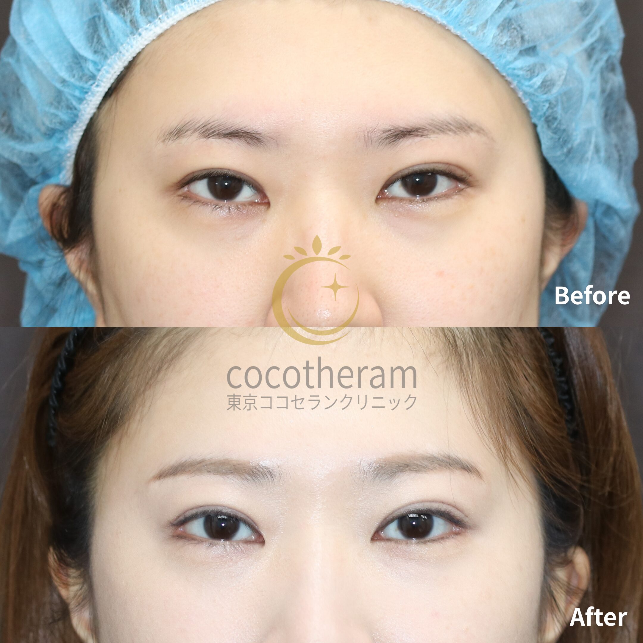 目尻切開 / グラマラスライン形成