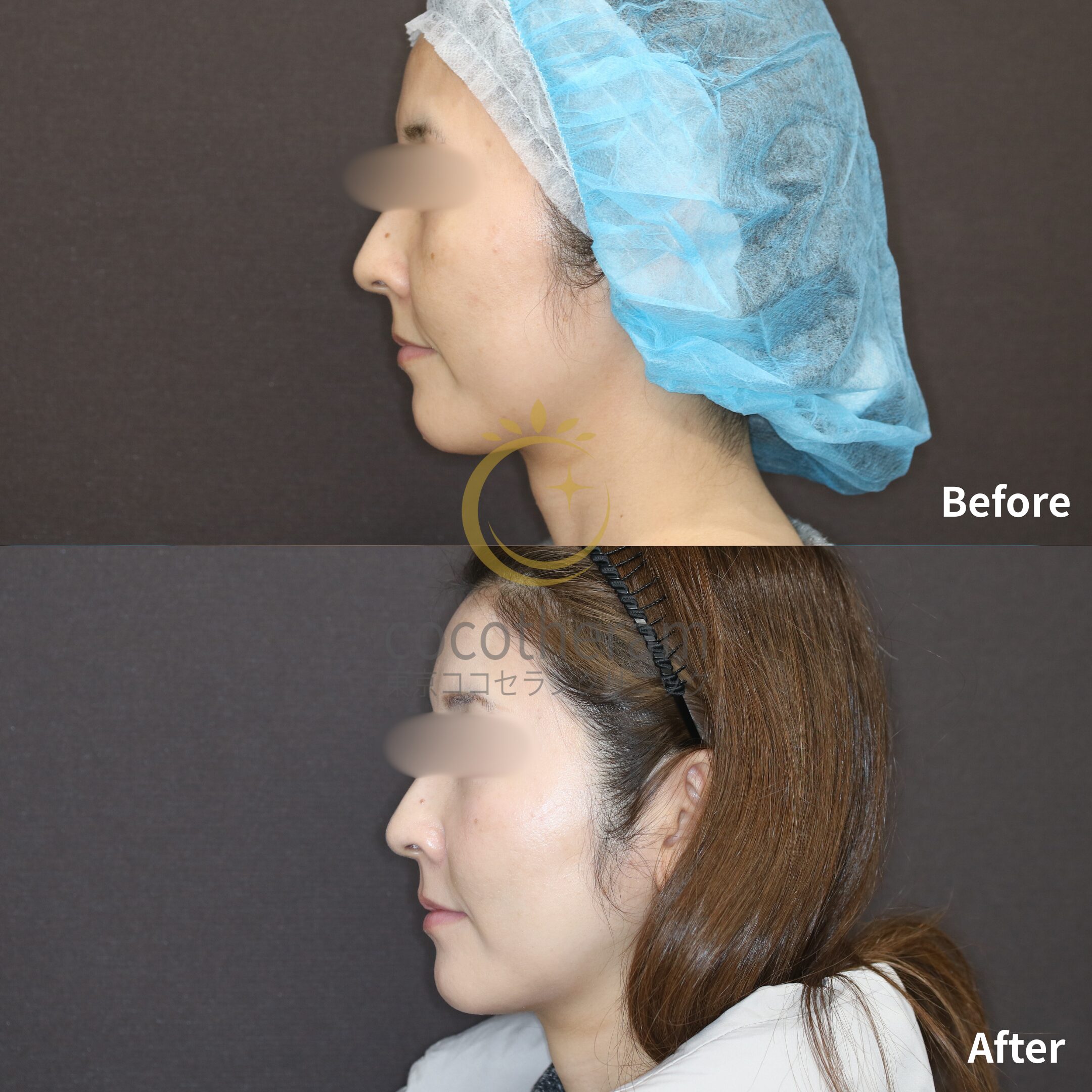 スレッドリフト