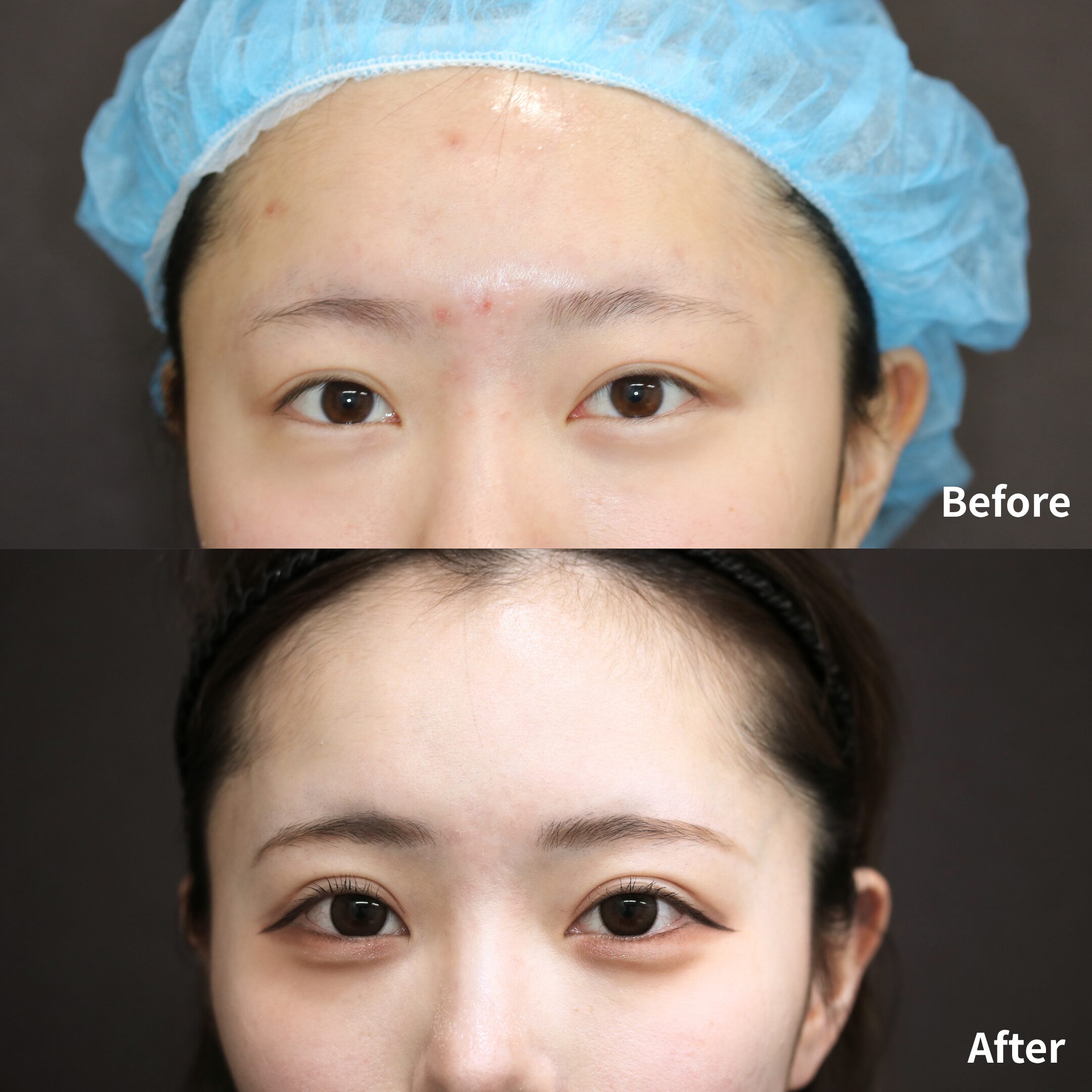 二重埋没法6点留め / ボトックス注射