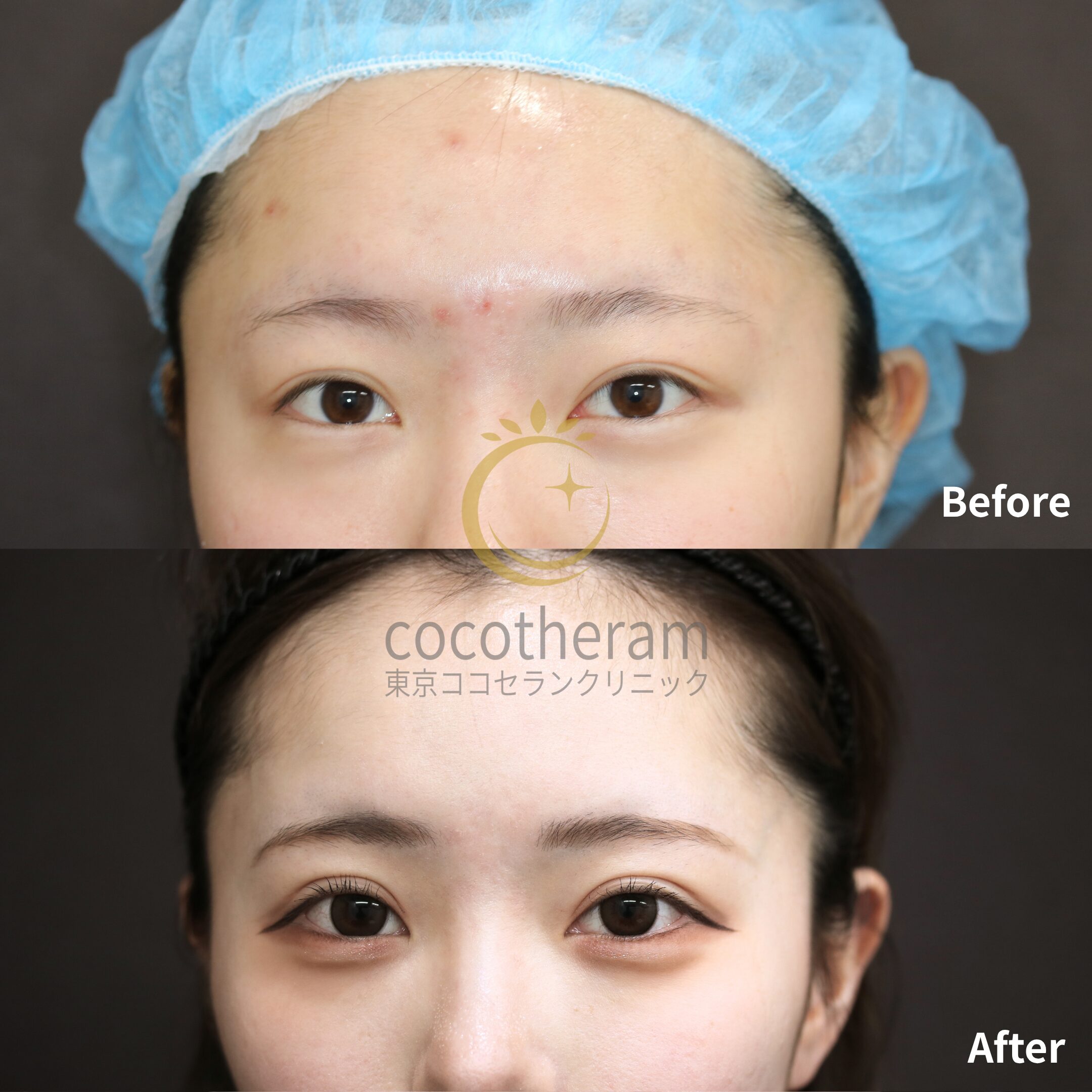 二重埋没法6点留め / ボトックス注射