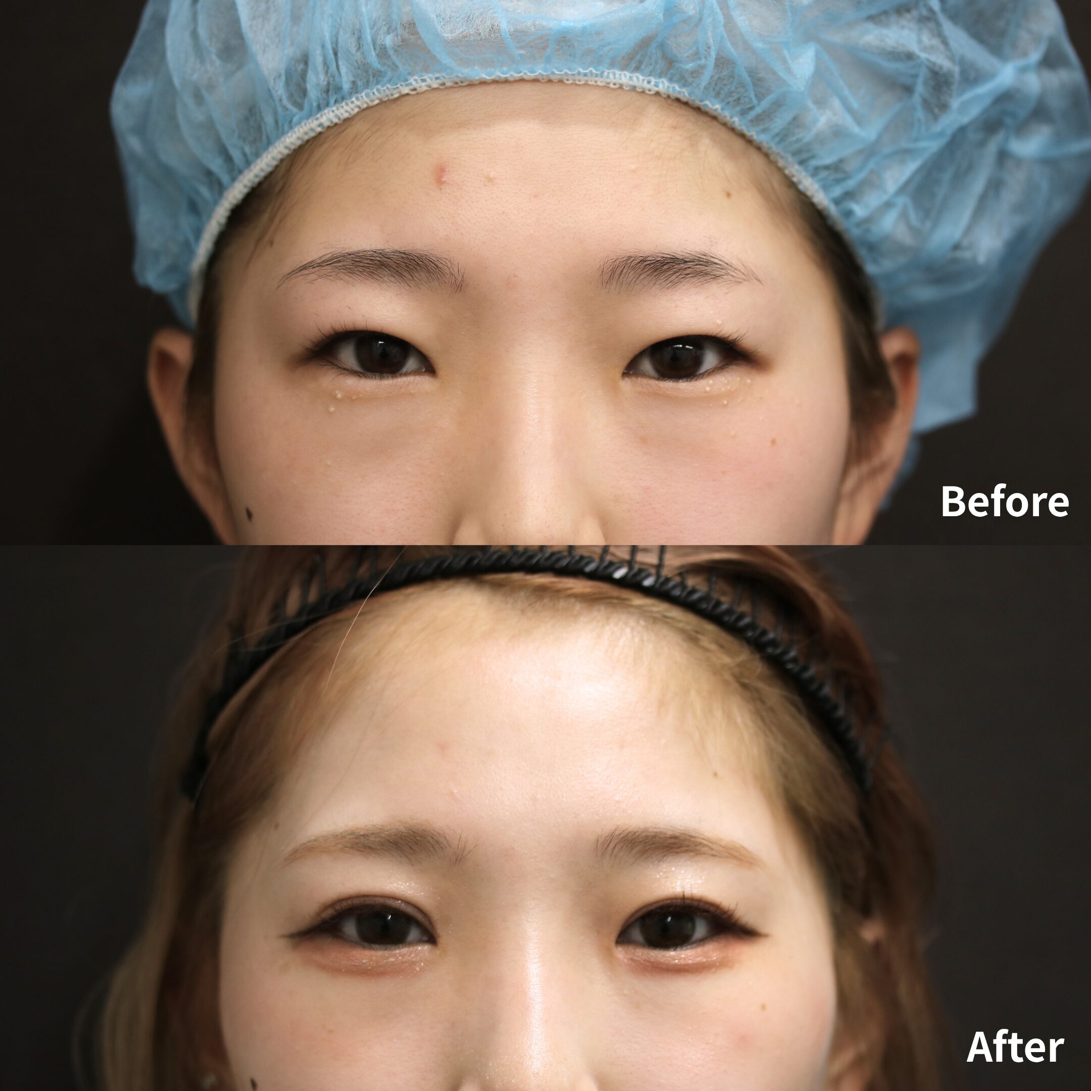 二重切開法 / 二重埋没抜糸法 / 上瞼脂肪取り