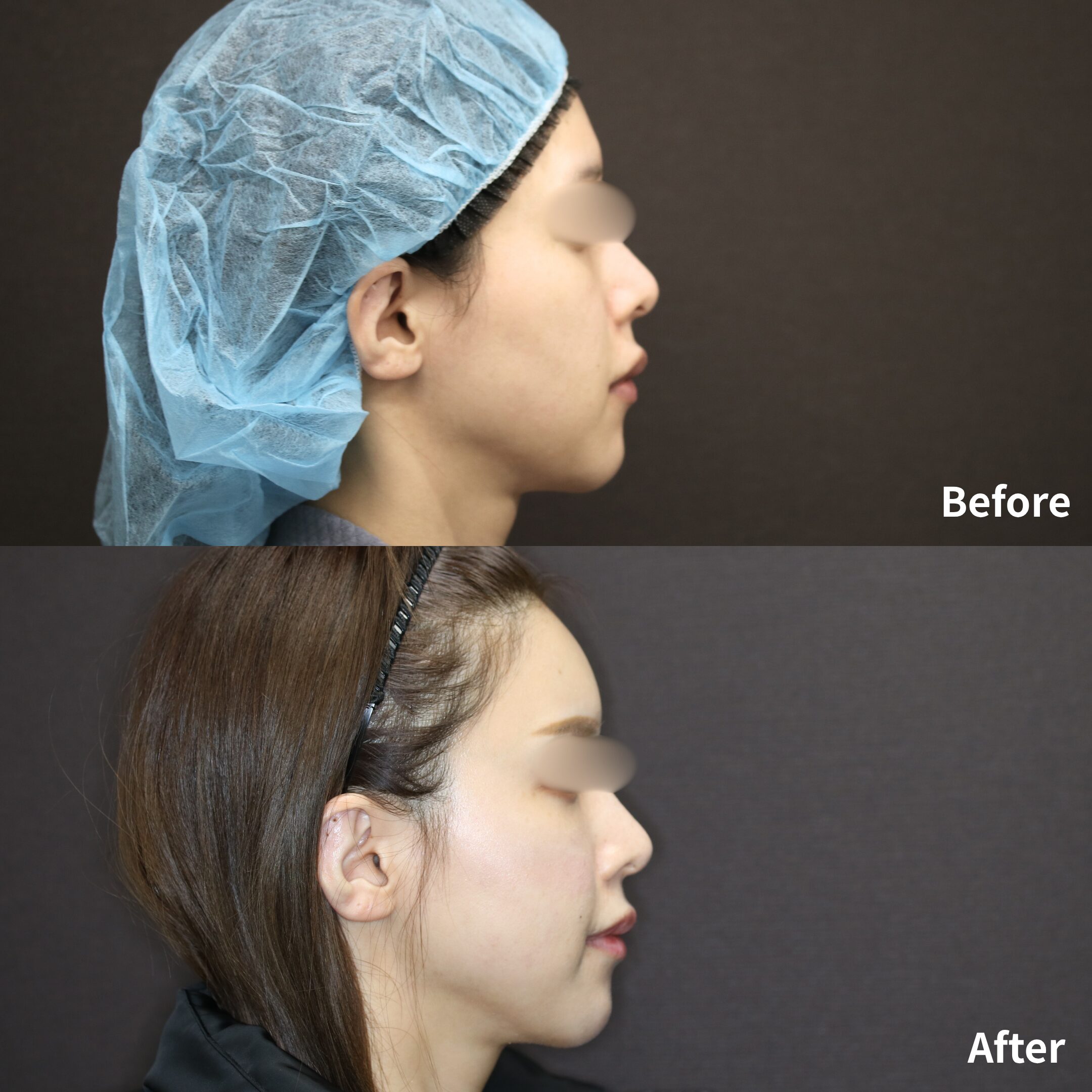 ミッドフェイスリフト / 脂肪注入