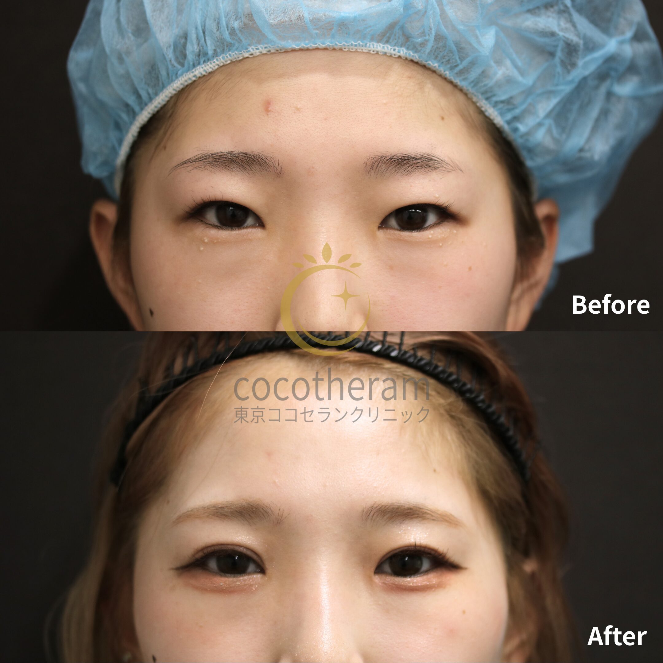 二重切開法 / 二重埋没抜糸法 / 上瞼脂肪取り