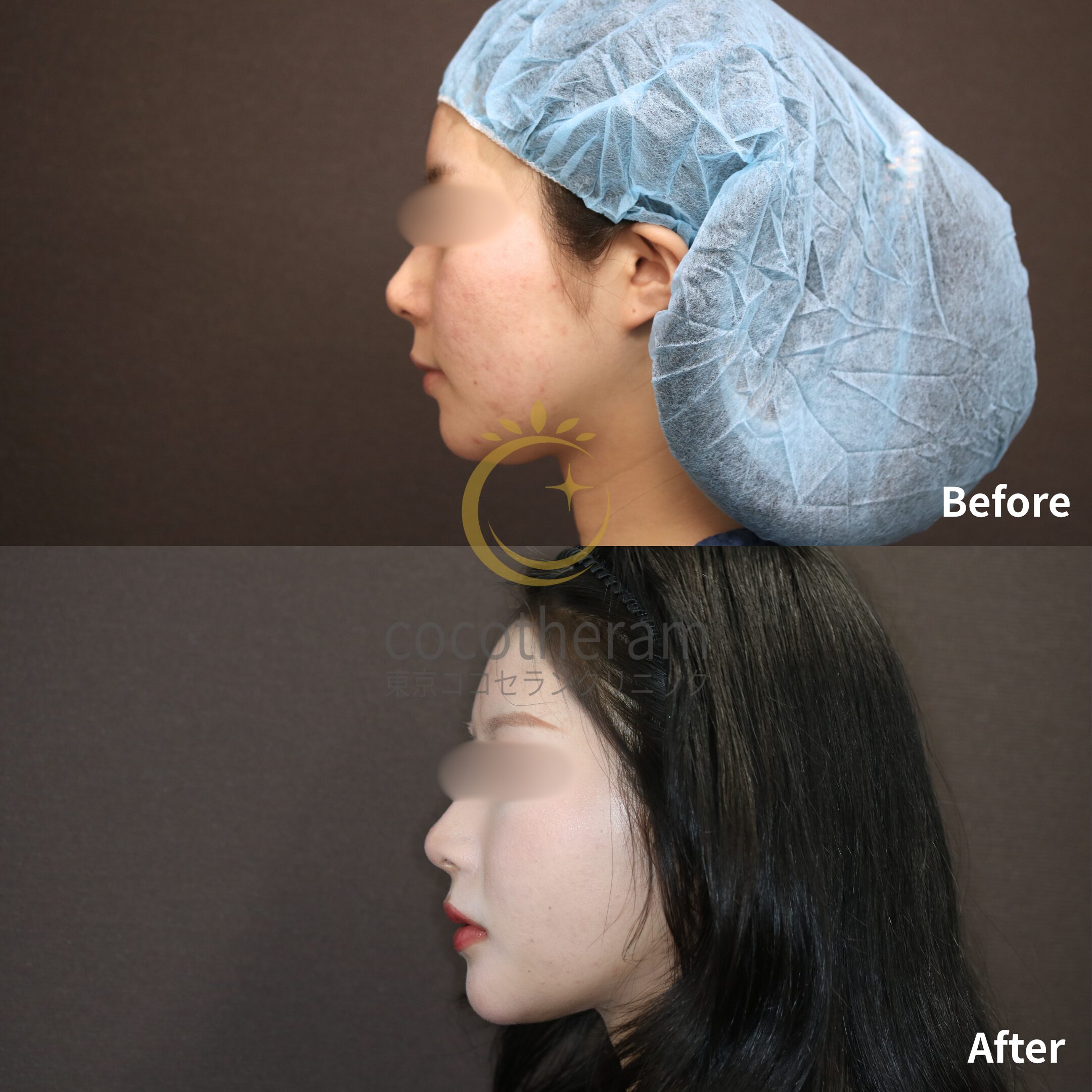 小顔マジック / 脂肪注入