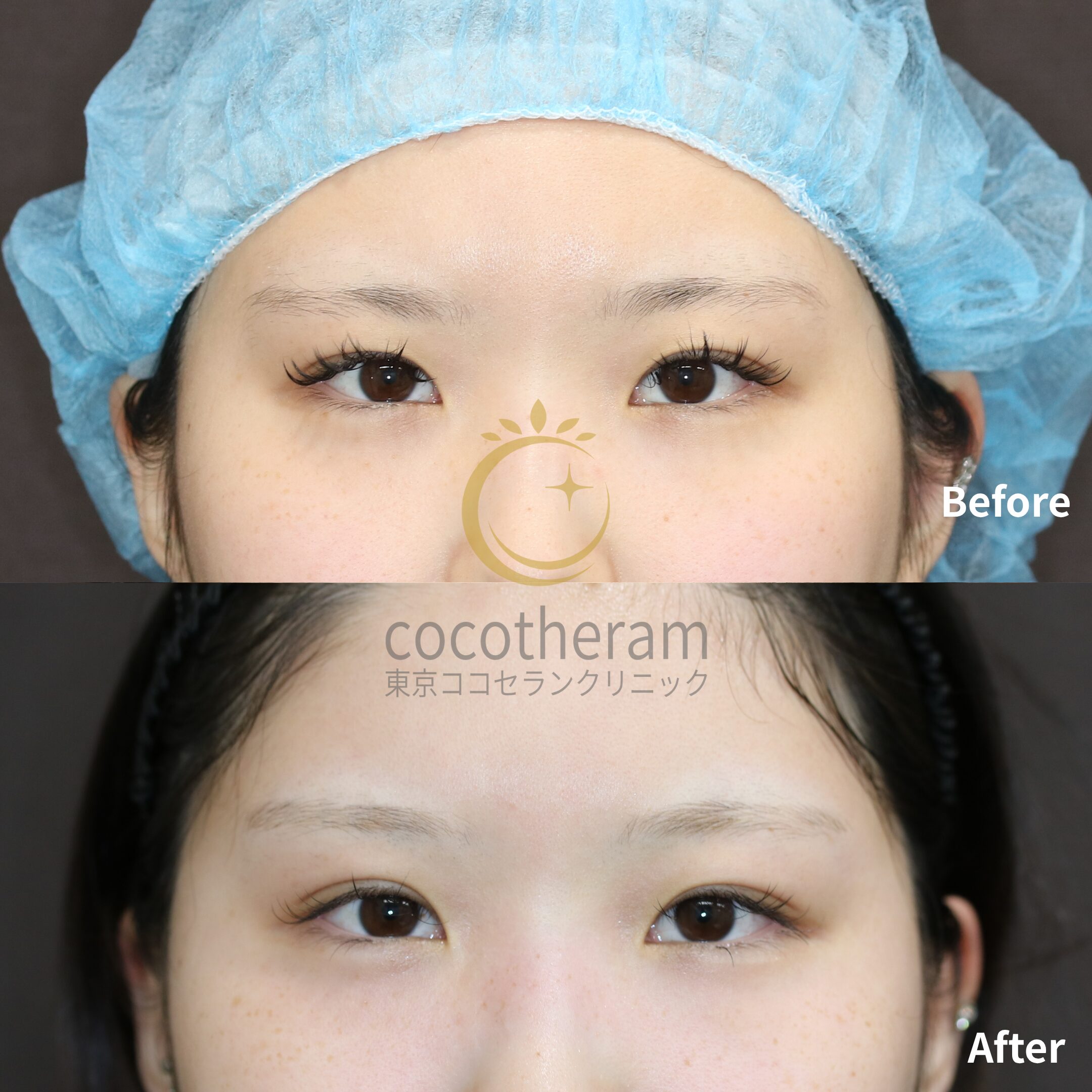 二重埋没法6点留め