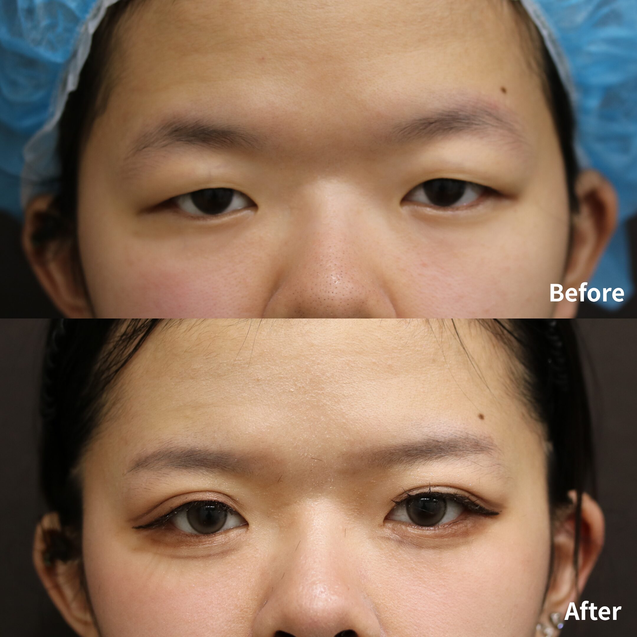 二重埋没法6点留め