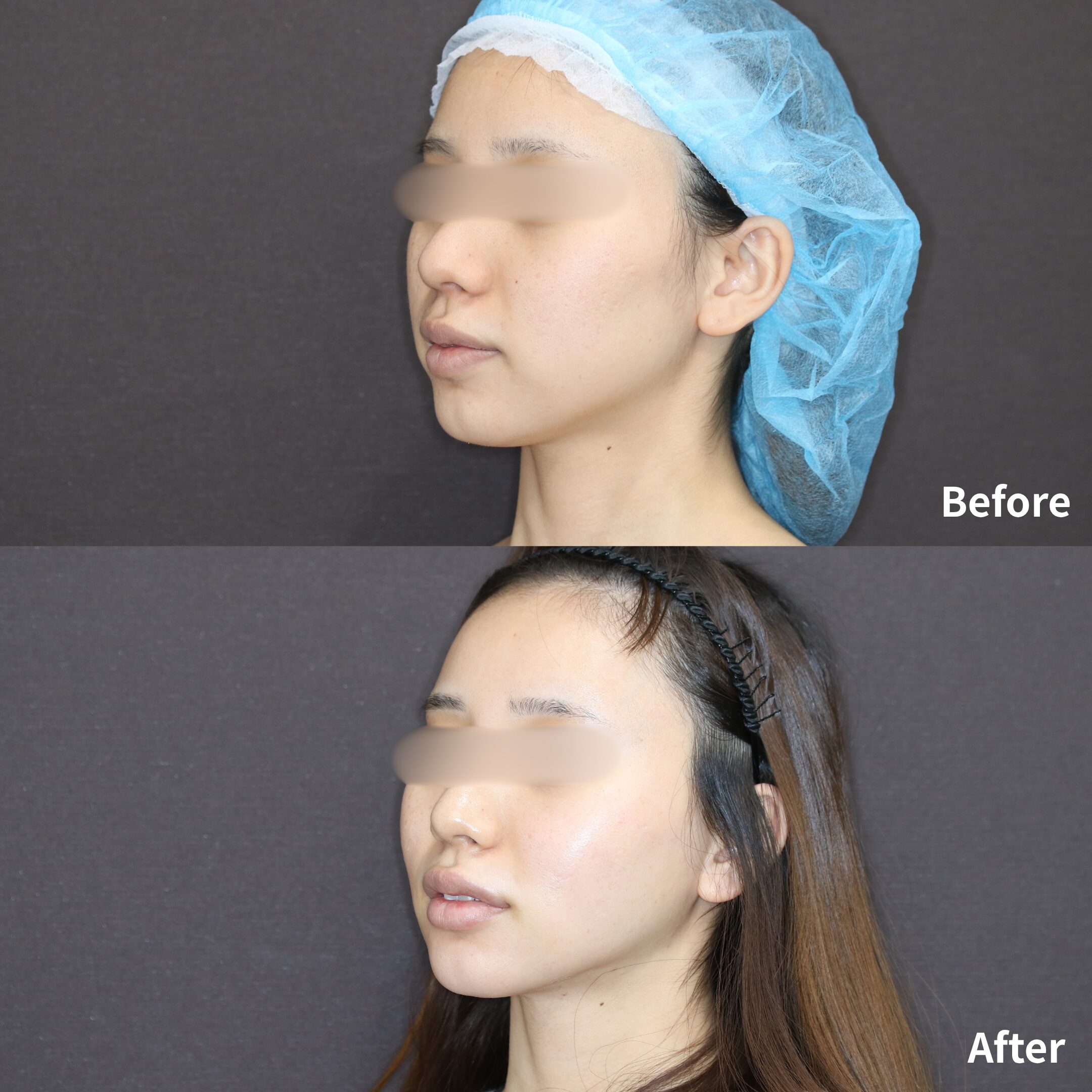 小顔マジック / 脂肪注入