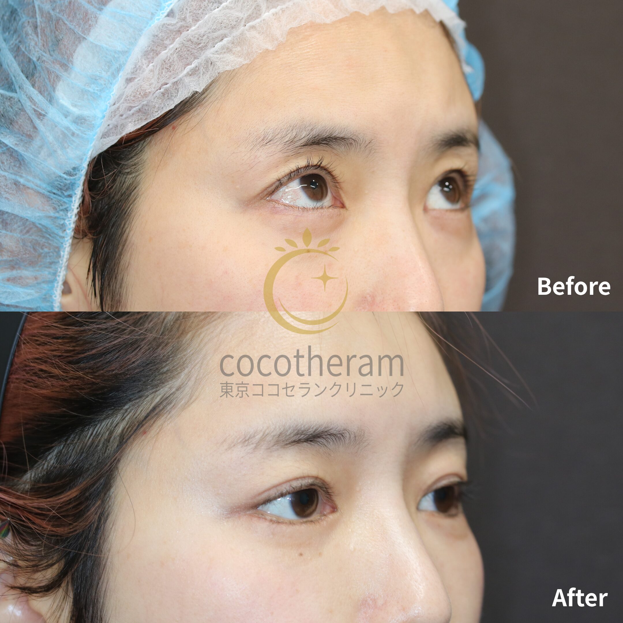 表ハムラ法 / 下眼瞼内反症手術