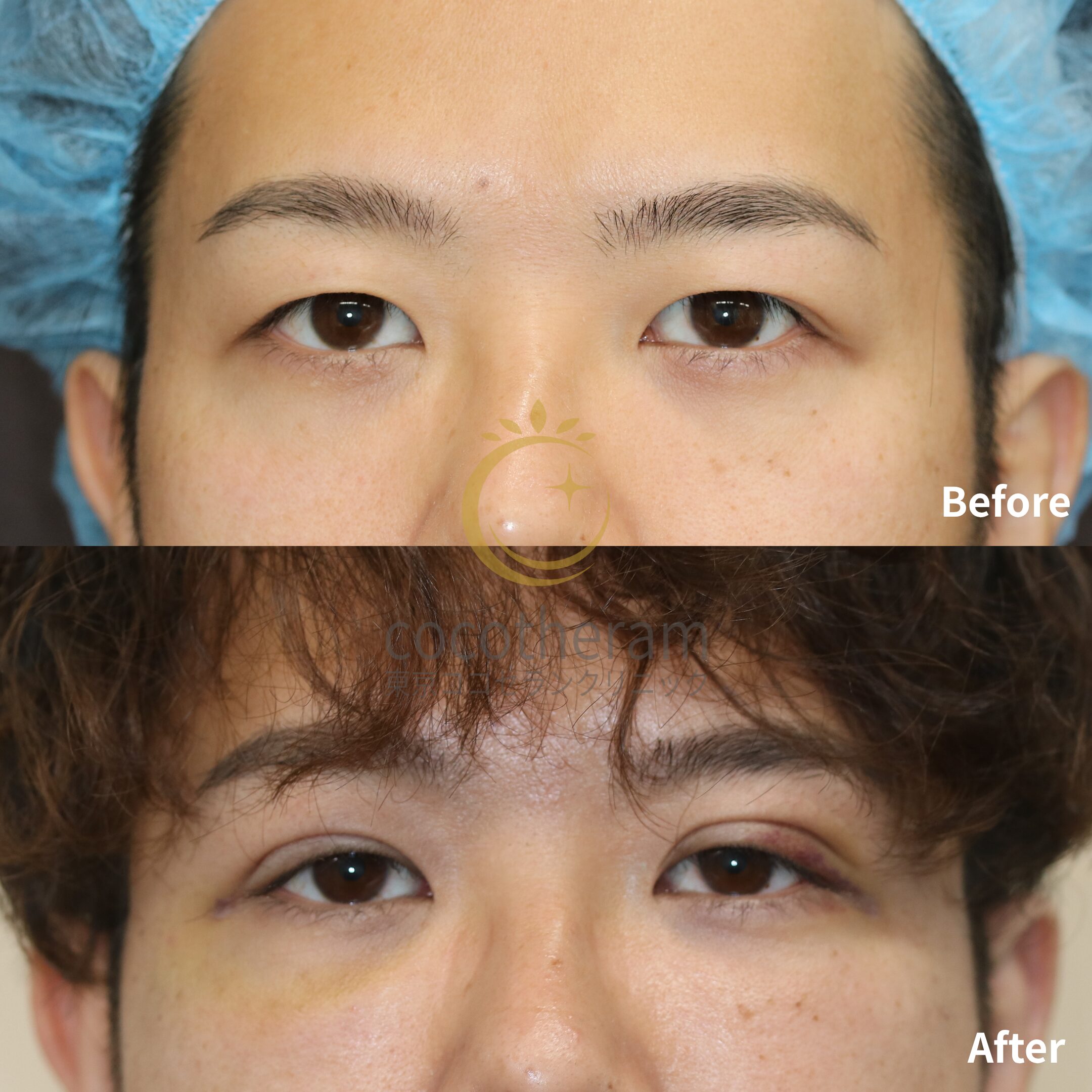 二重埋没法3点留め / 脂肪注入