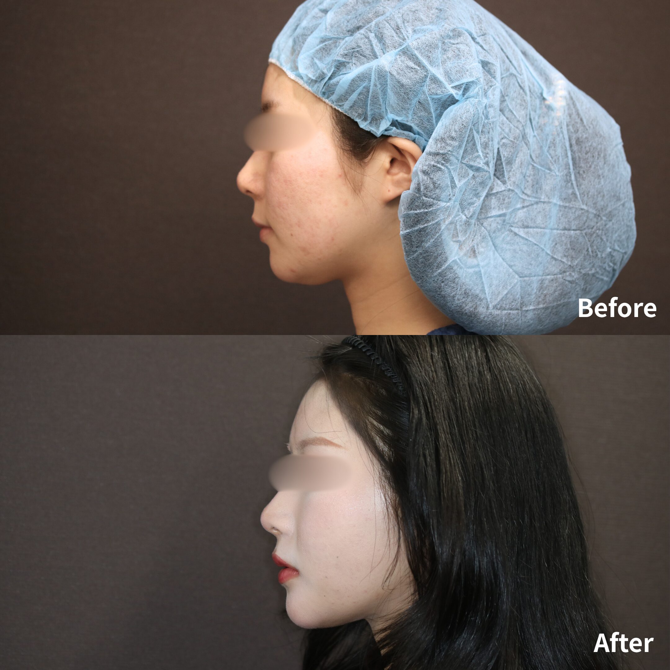 小顔マジック / 脂肪注入