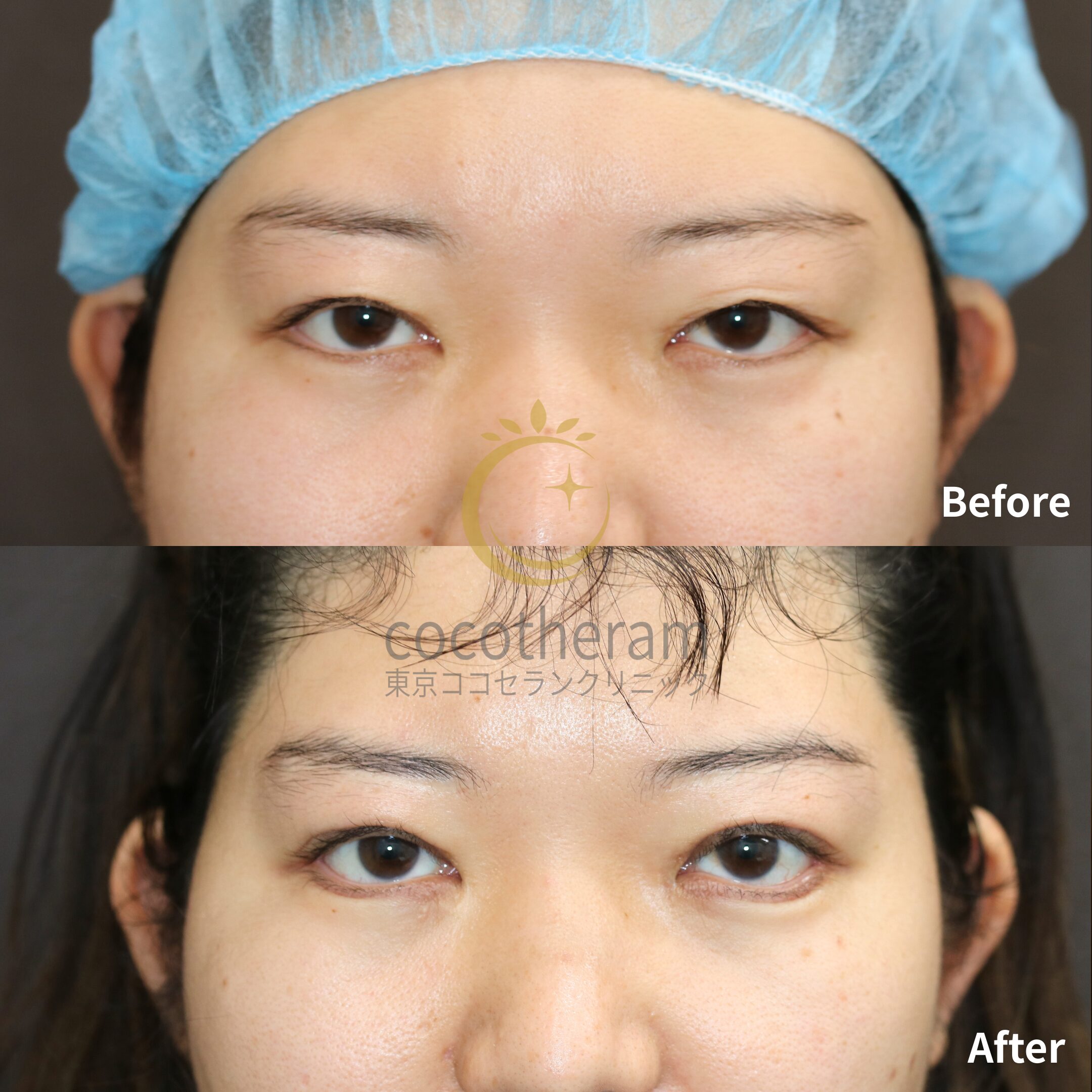 目尻切開 / グラマラスライン形成 / 二重切開法