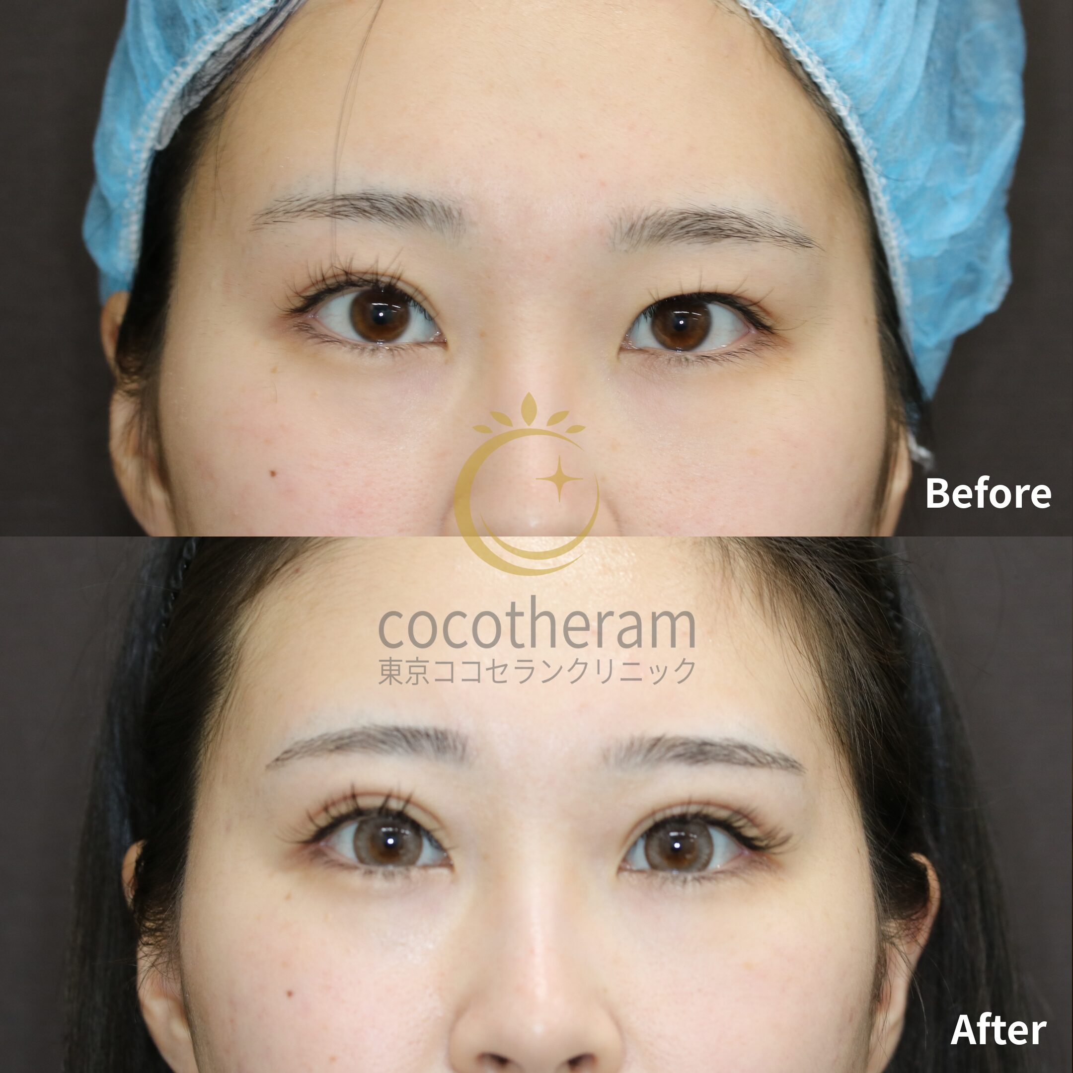 二重埋没法6点留め