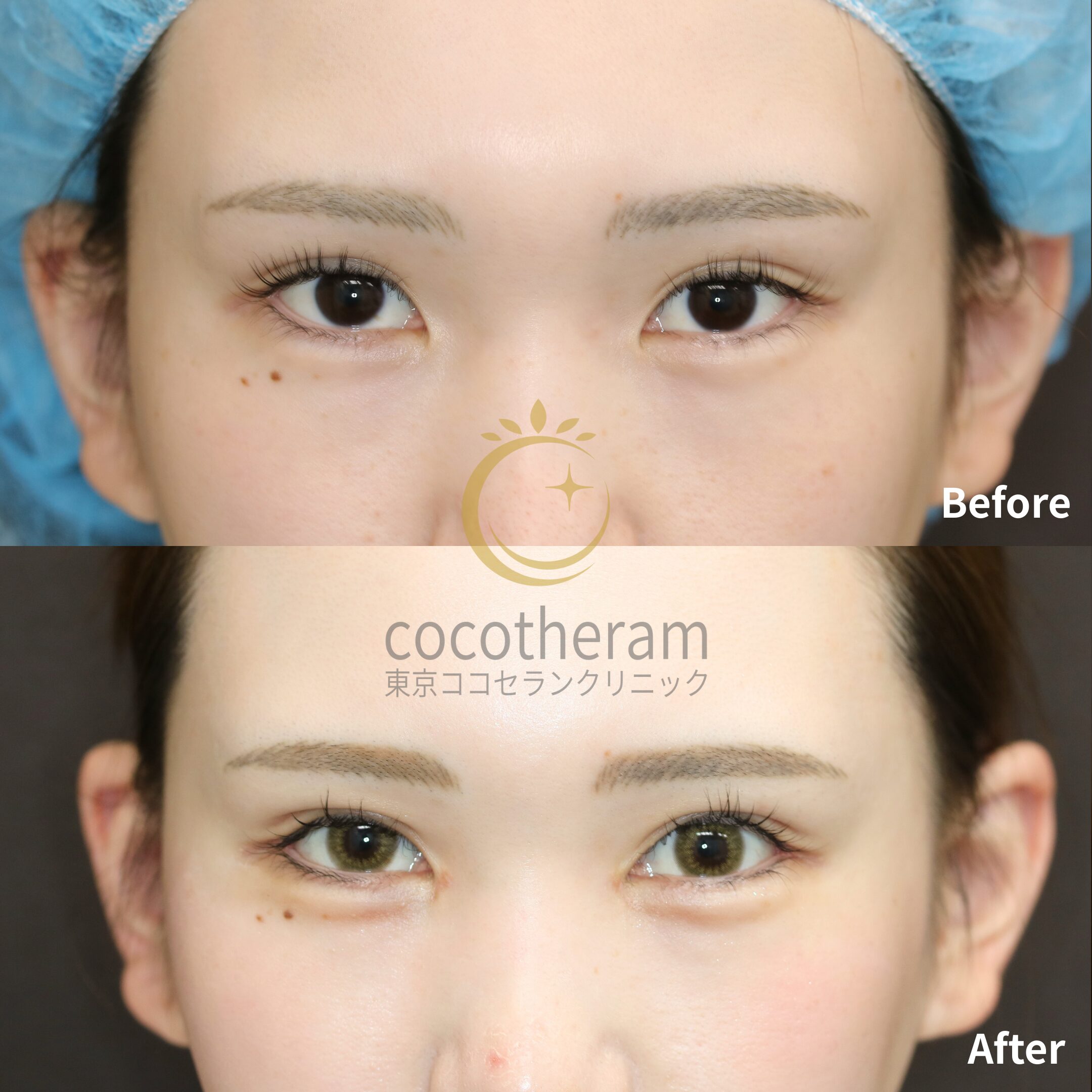 目尻切開 / グラマラスライン形成 / 眼瞼下垂症手術 / 上眼瞼脂肪取り / 目頭切開 / 二重埋没抜糸法