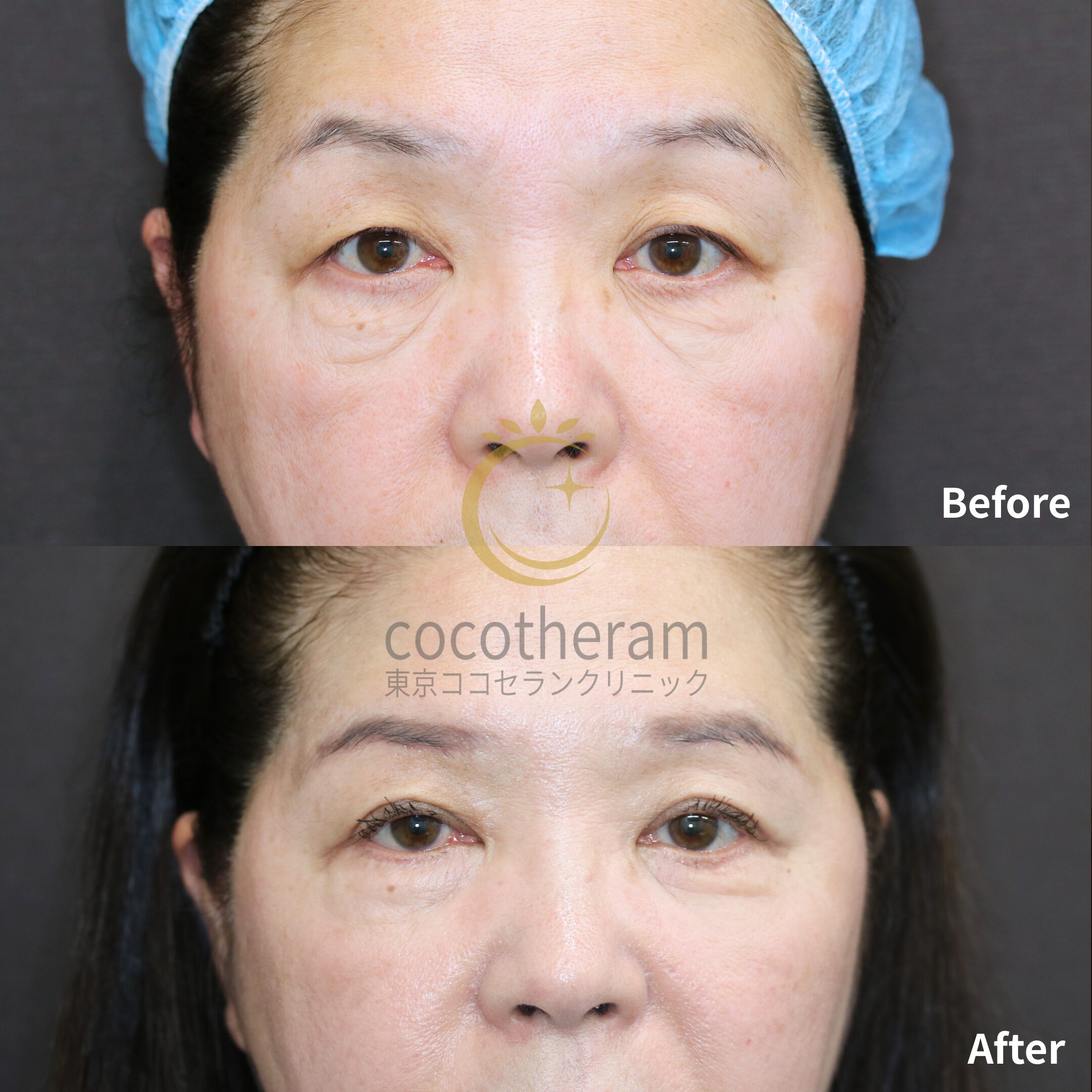 ミッドフェイスリフト / 表ハムラ法 / 二重埋没法 / 眉下切開