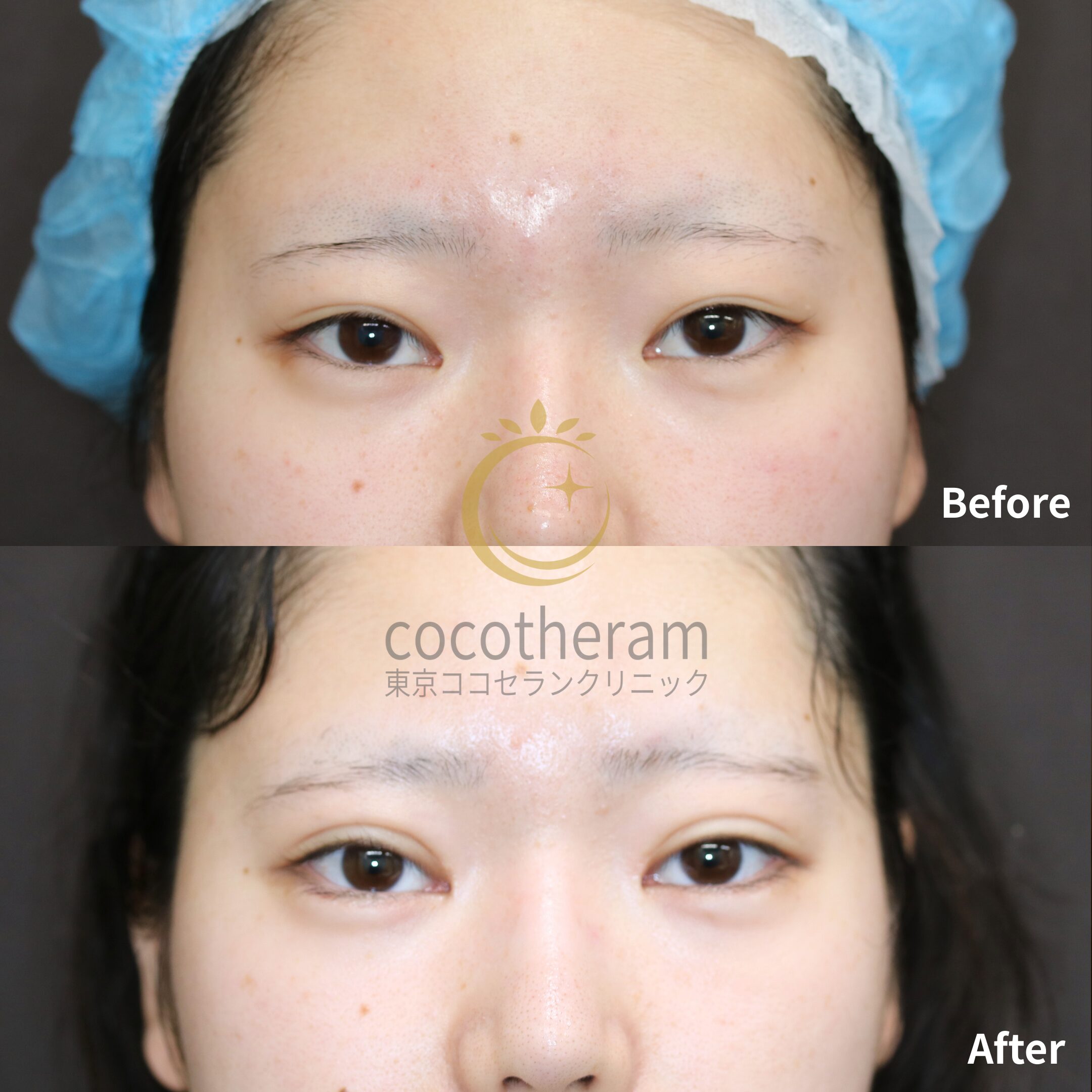 目尻切開 / グラマラスライン形成 / 二重埋没法 / 目頭切開