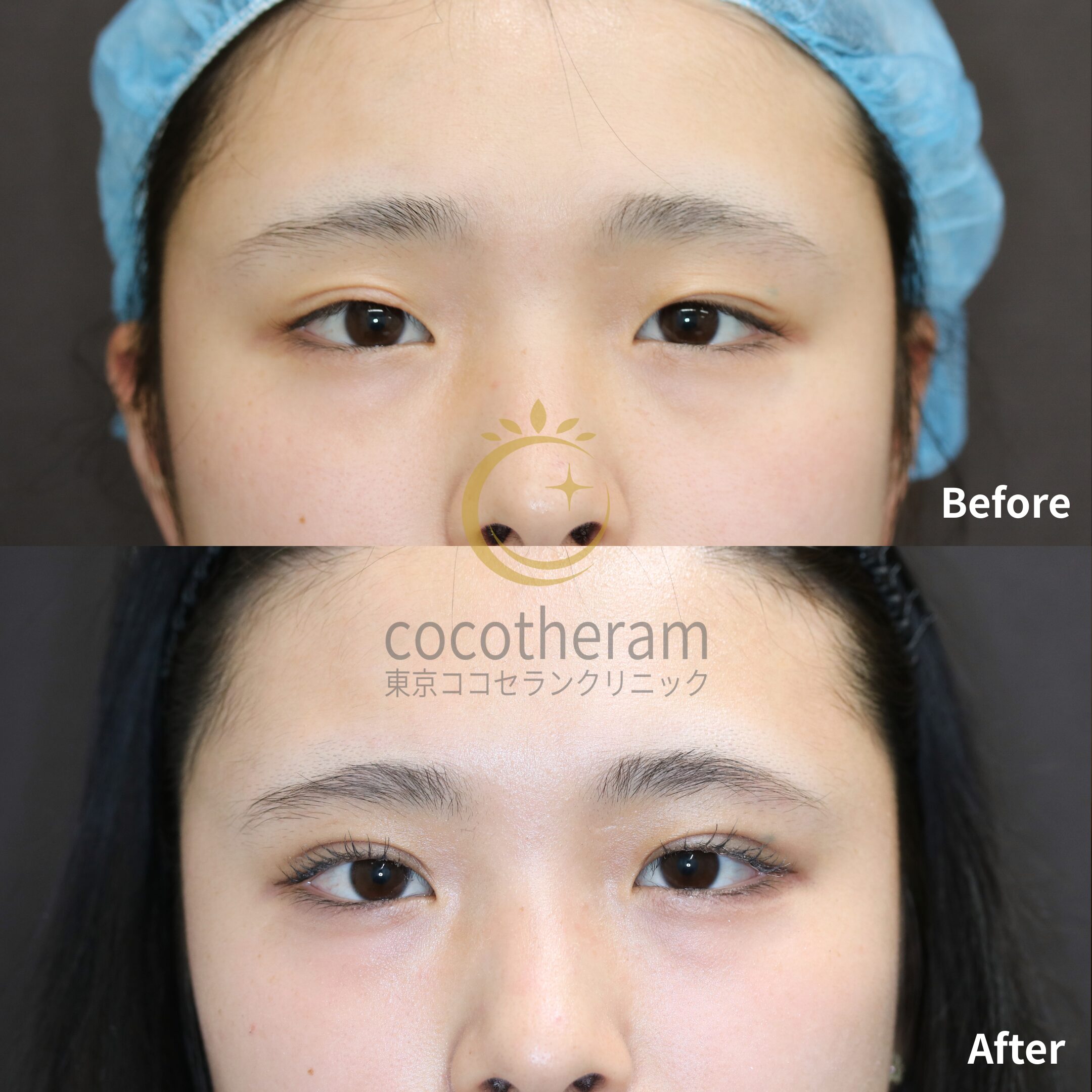 二重埋没法6点留め