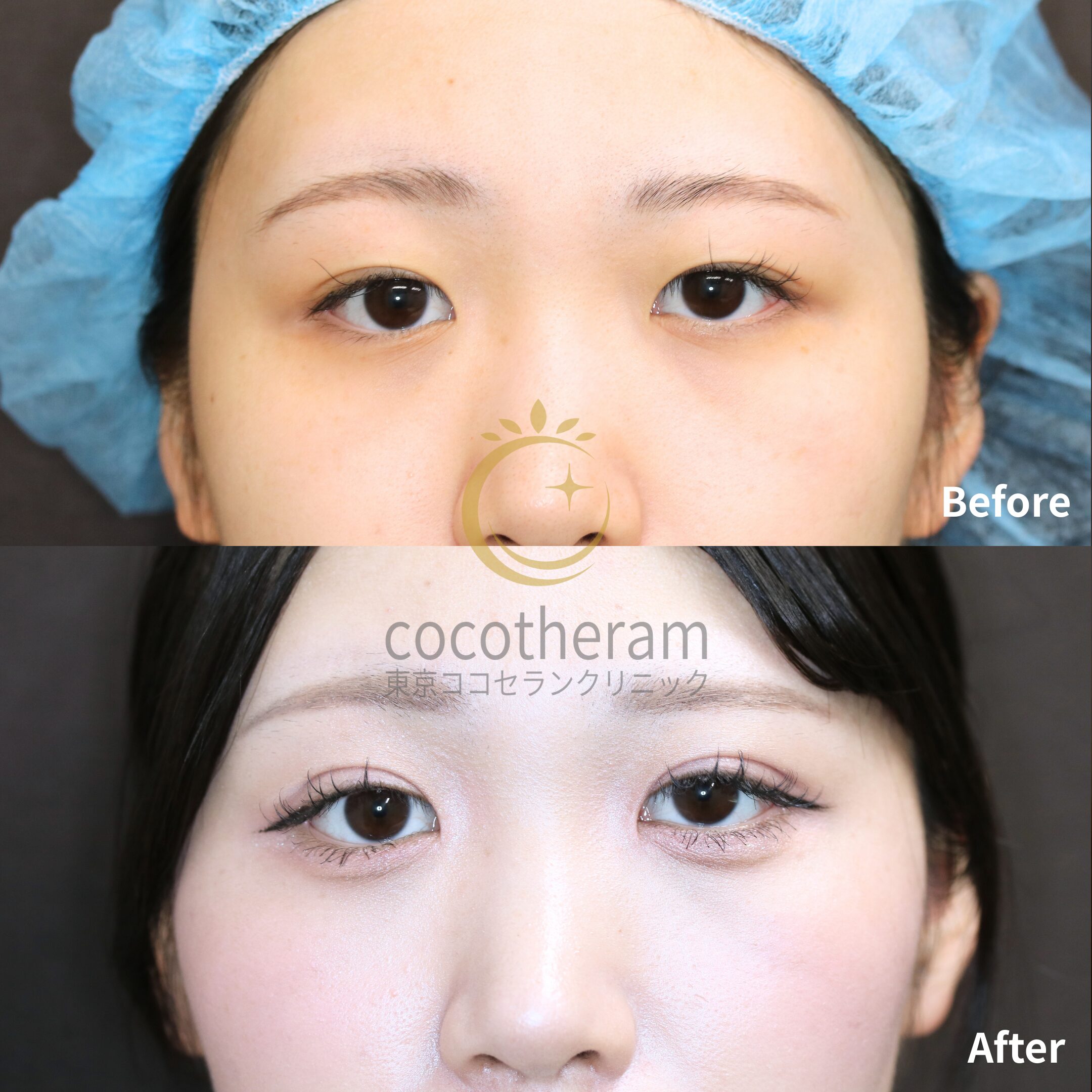 二重埋没法6点留め / 目頭切開